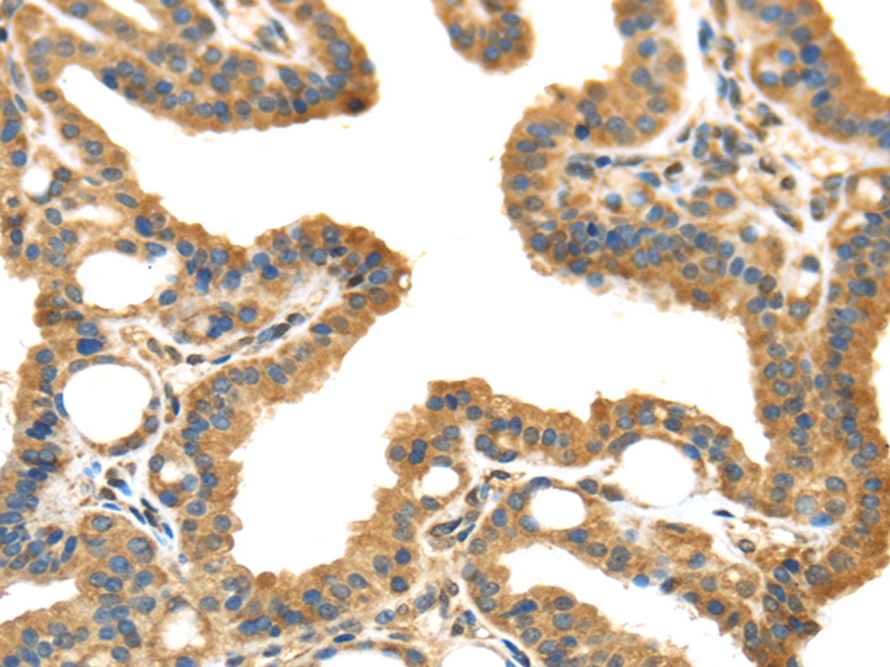 Immunohistochemistry of paraffin-embedded Human thyroid cancer using IL3RA Polyclonal Antibody at dilution of  1/35