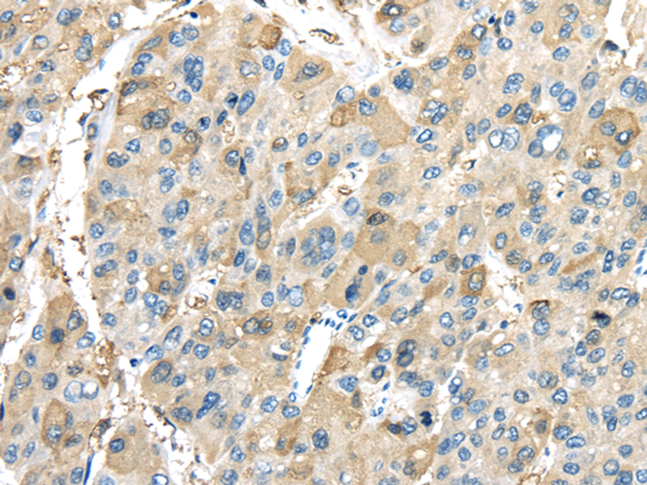 Immunohistochemistry of paraffin-embedded Human liver cancer tissue using INHBB Polyclonal Antibody at dilution 1:45