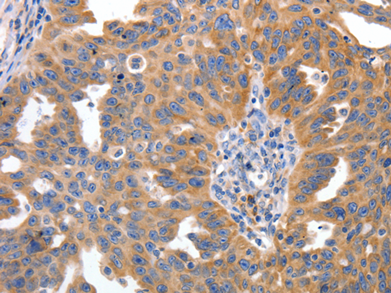 Immunohistochemistry of paraffin-embedded Human ovarian cancer tissue using IRS2 Polyclonal Antibody at dilution 1:100