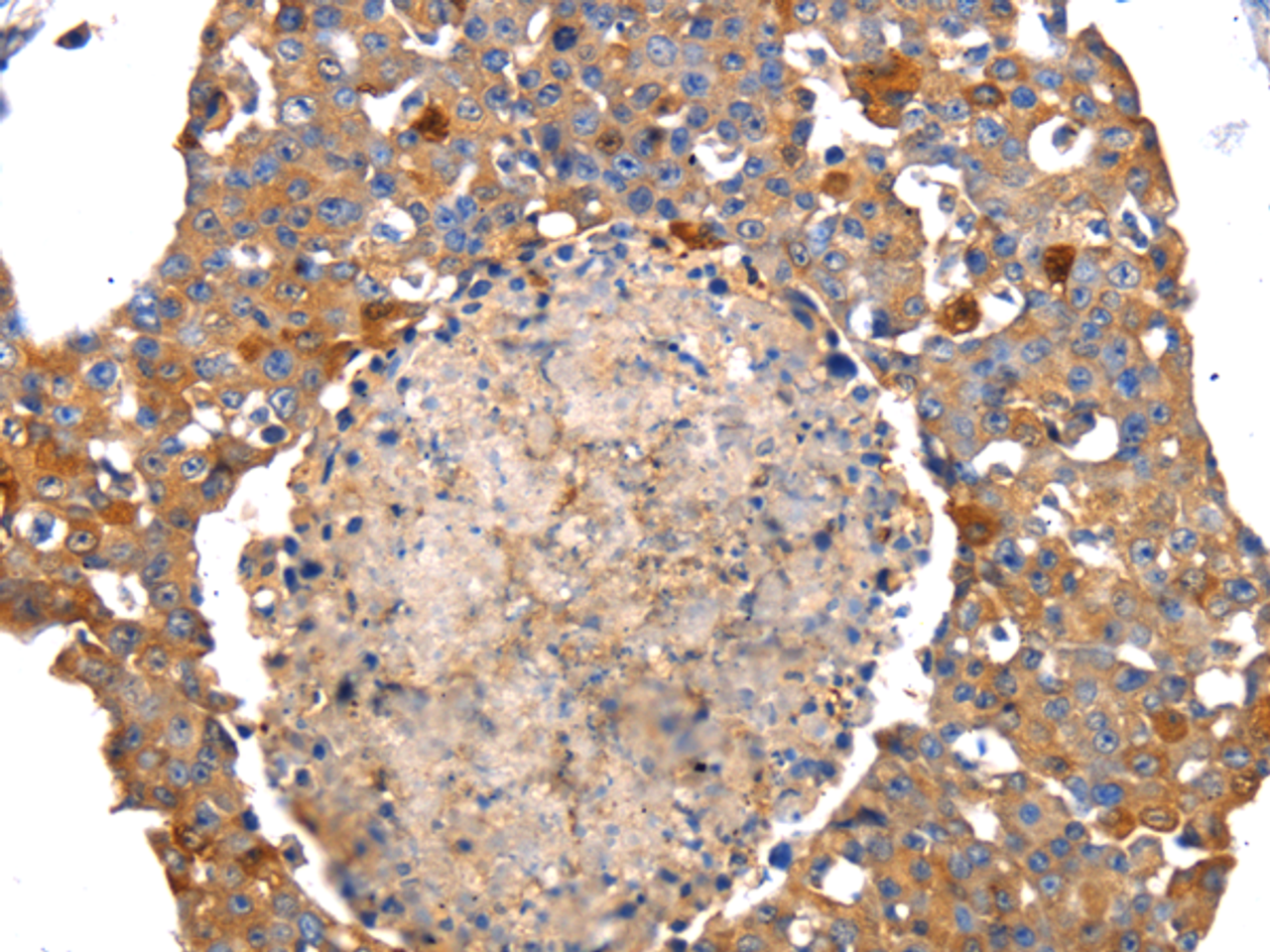 Immunohistochemistry of paraffin-embedded Human breast cancer tissue using IRS2 Polyclonal Antibody at dilution 1:100