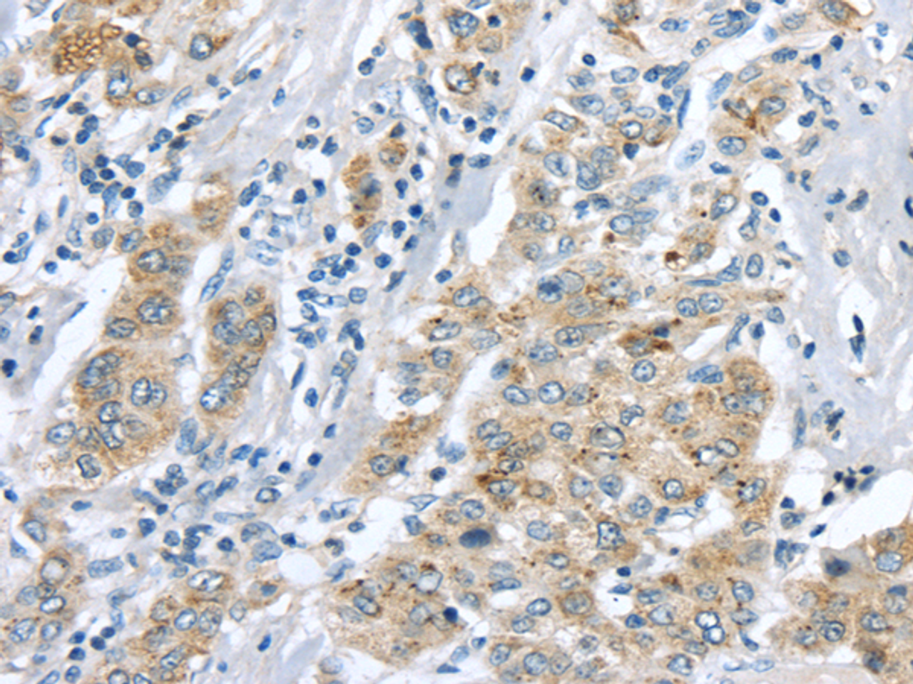 Immunohistochemistry of paraffin-embedded Human liver cancer tissue using LRP6 Polyclonal Antibody at dilution 1:60