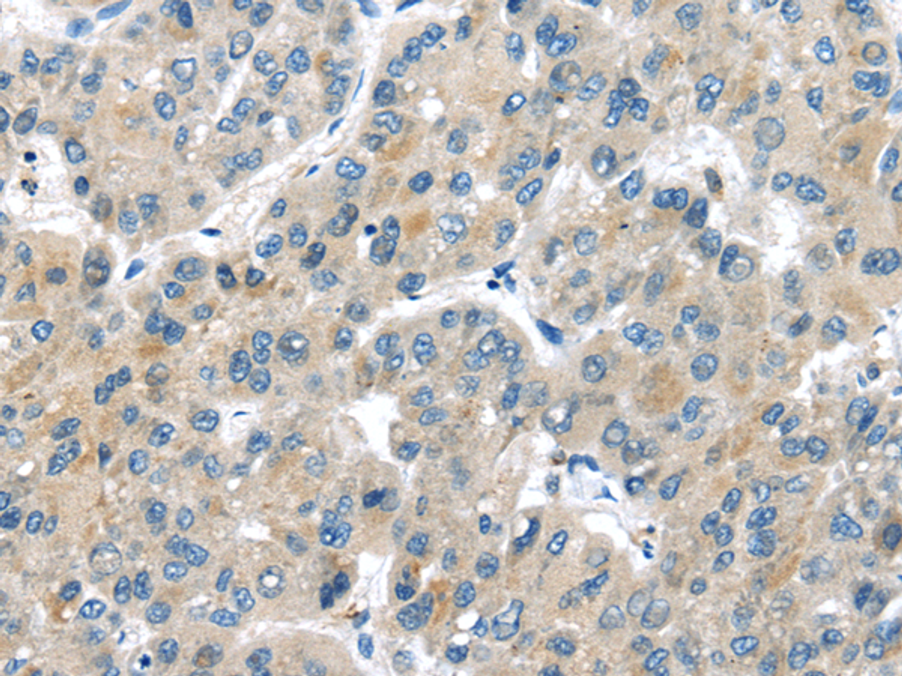 Immunohistochemistry of paraffin-embedded Human liver cancer tissue using MASP2 Polyclonal Antibody at dilution 1:35