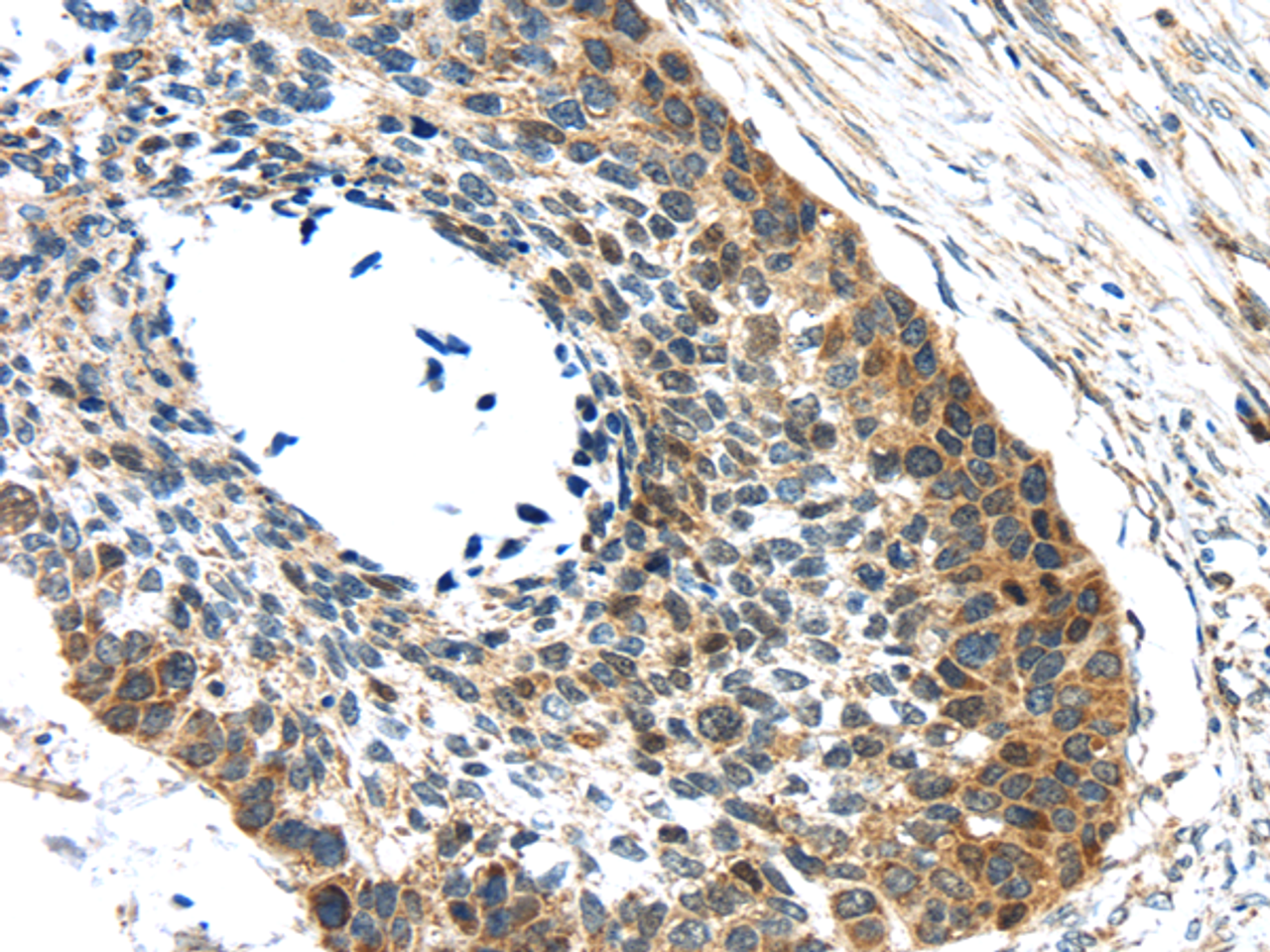 Immunohistochemistry of paraffin-embedded Human esophagus cancer tissue using GRIN2A Polyclonal Antibody at dilution 1:30
