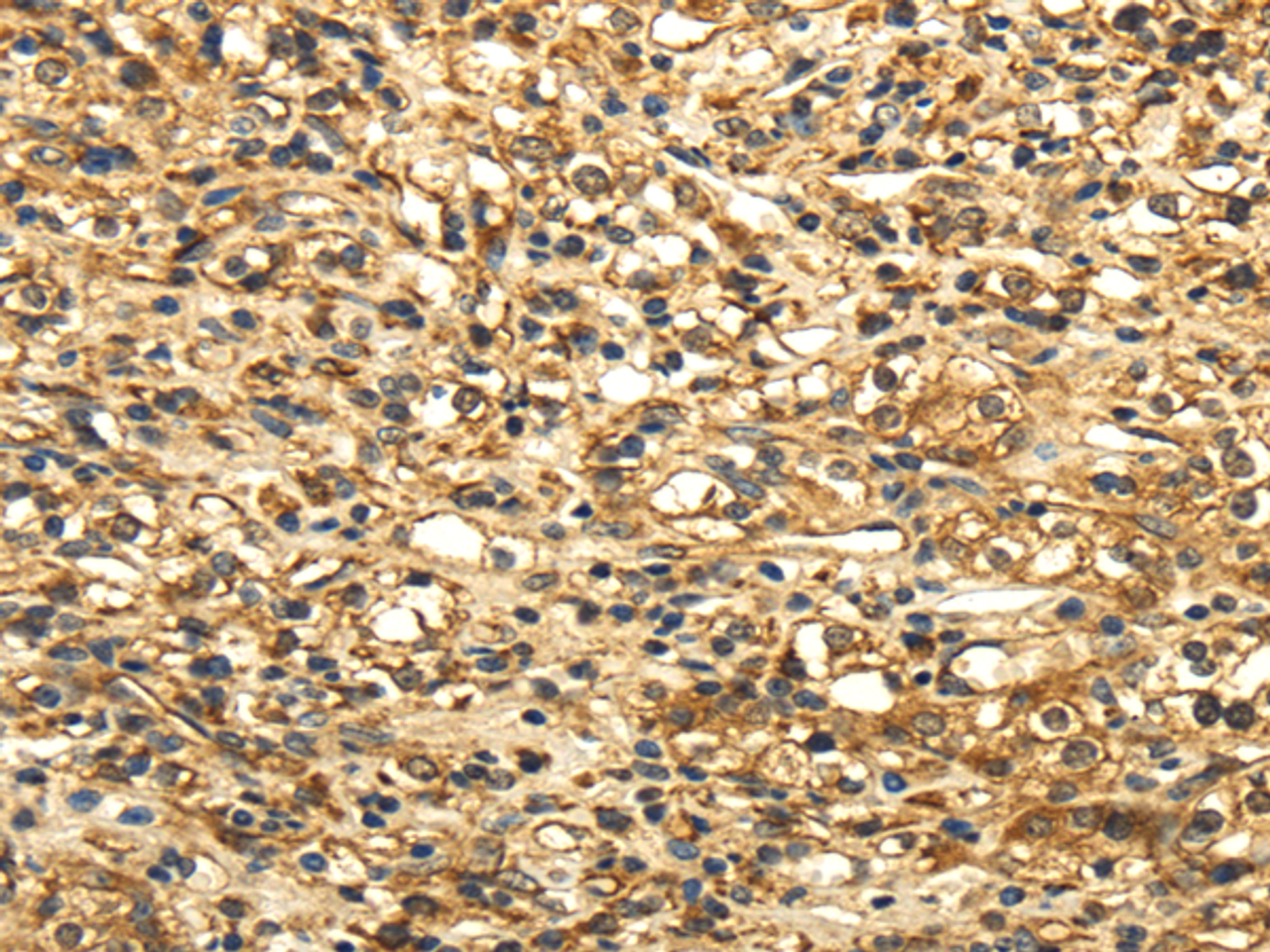 Immunohistochemistry of paraffin-embedded Human prostate cancer tissue using SLC6A19 Polyclonal Antibody at dilution 1:35
