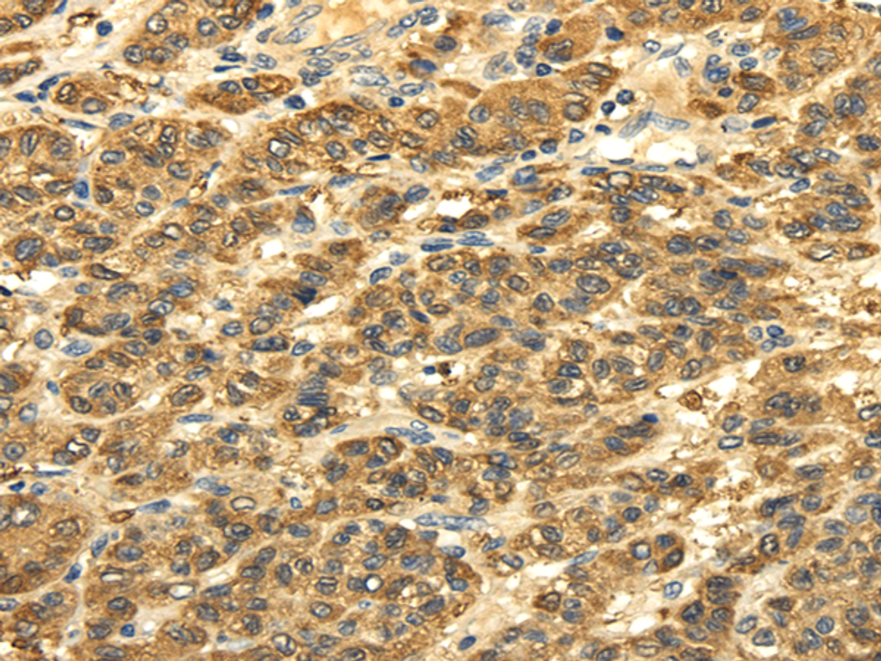 Immunohistochemistry of paraffin-embedded Human liver cancer tissue using SLC6A19 Polyclonal Antibody at dilution 1:35