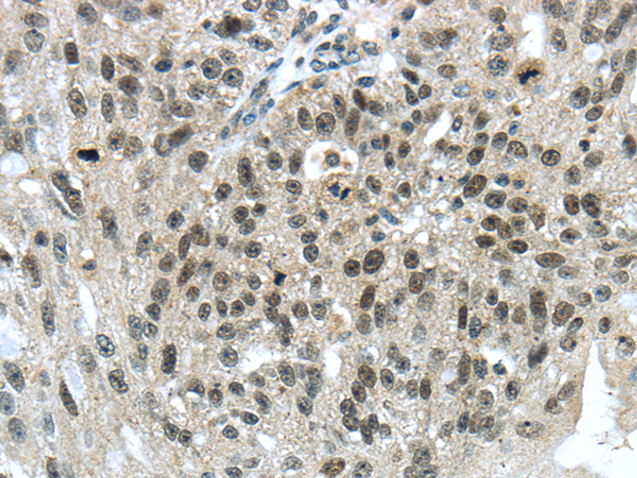 Immunohistochemistry of paraffin-embedded Human breast cancer using TRIM24 Polyclonal Antibody at dilution of  1/40
