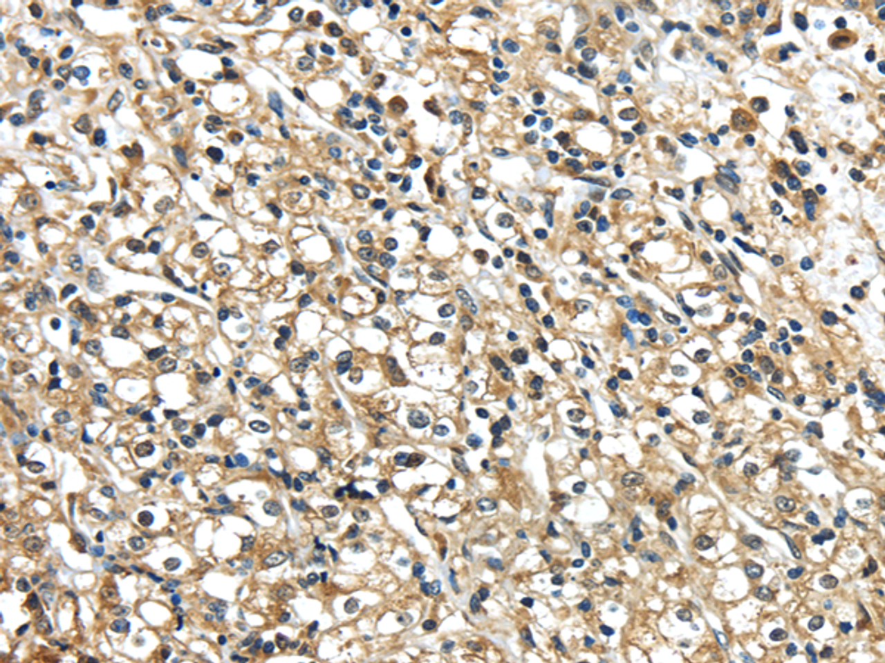 Immunohistochemistry of paraffin-embedded Human prostate cancer using NME2 Polyclonal Antibody at dilution of  1/40