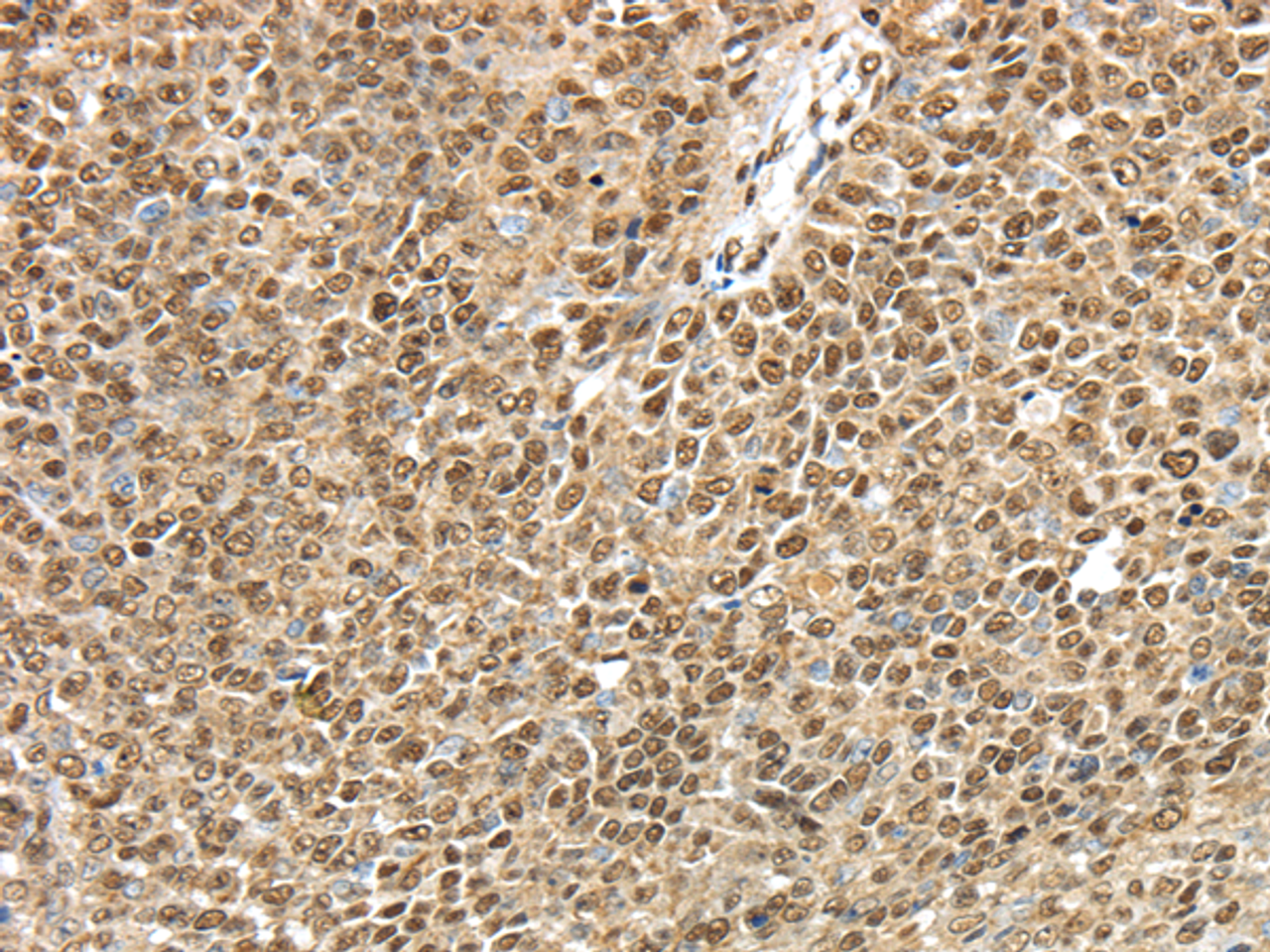 Immunohistochemistry of paraffin-embedded Human ovarian cancer tissue using TRIM33 Polyclonal Antibody at dilution 1:40