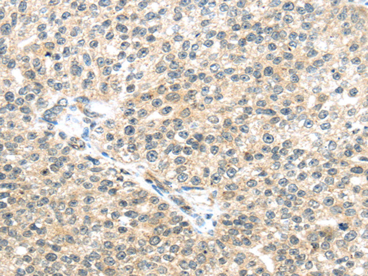 Immunohistochemistry of paraffin-embedded Human breast cancer tissue using TTBK2 Polyclonal Antibody at dilution 1:45