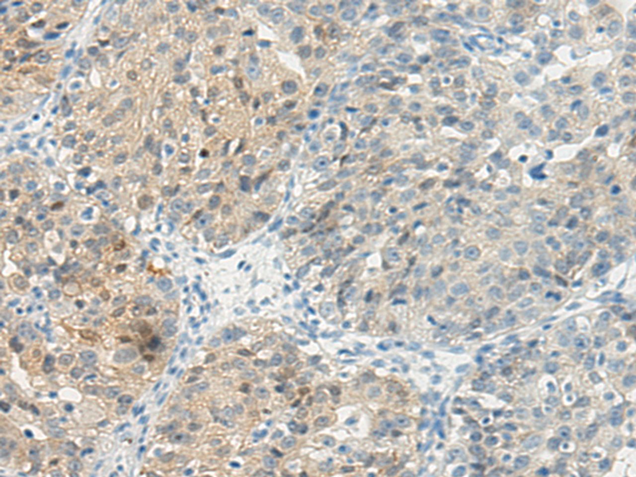Immunohistochemistry of paraffin-embedded Human breast cancer tissue using TBXA2R Polyclonal Antibody at dilution 1:45