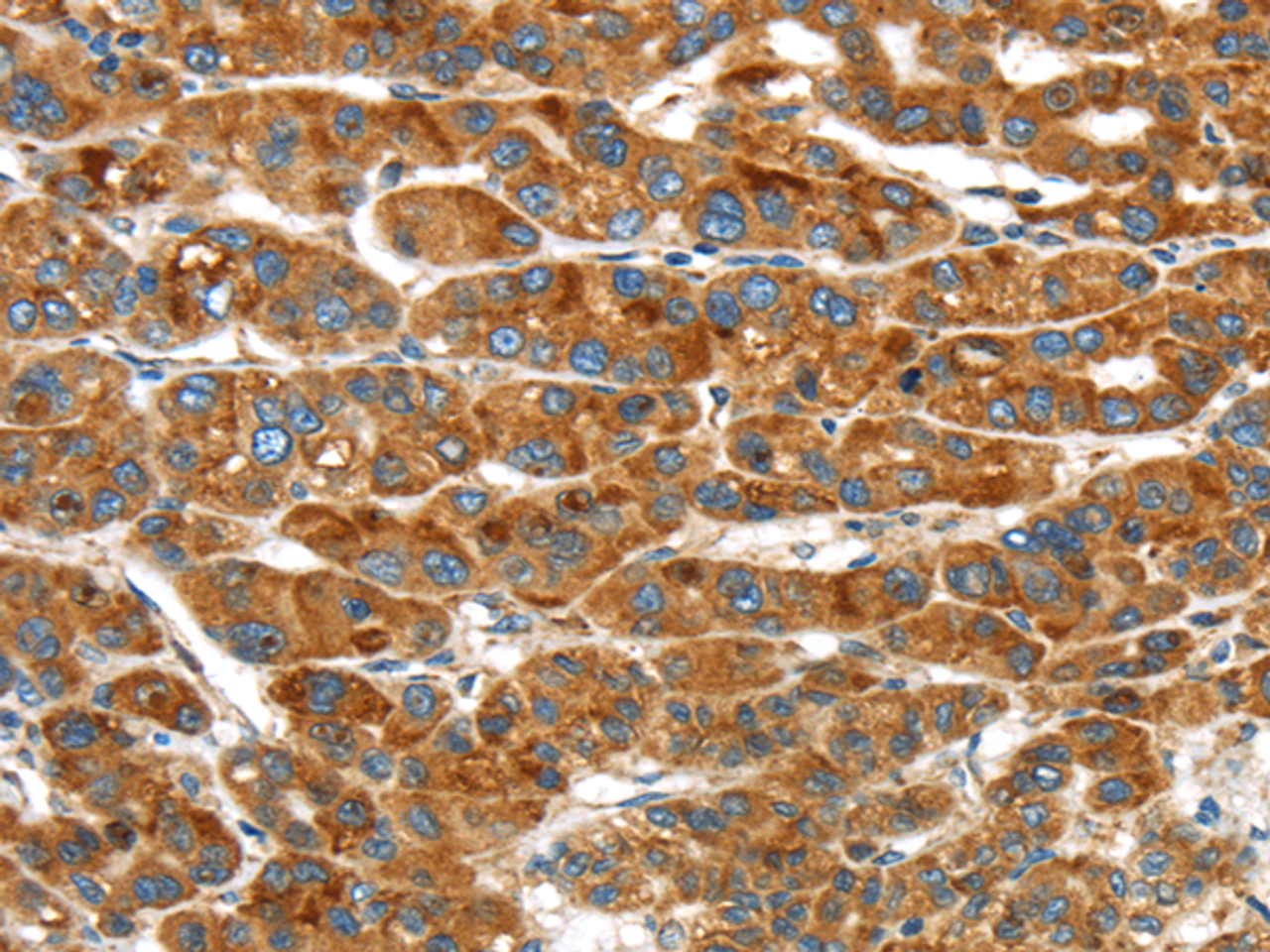 Immunohistochemistry of paraffin-embedded Human liver cancer using ERP44 Polyclonal Antibody at dilution of  1/20
