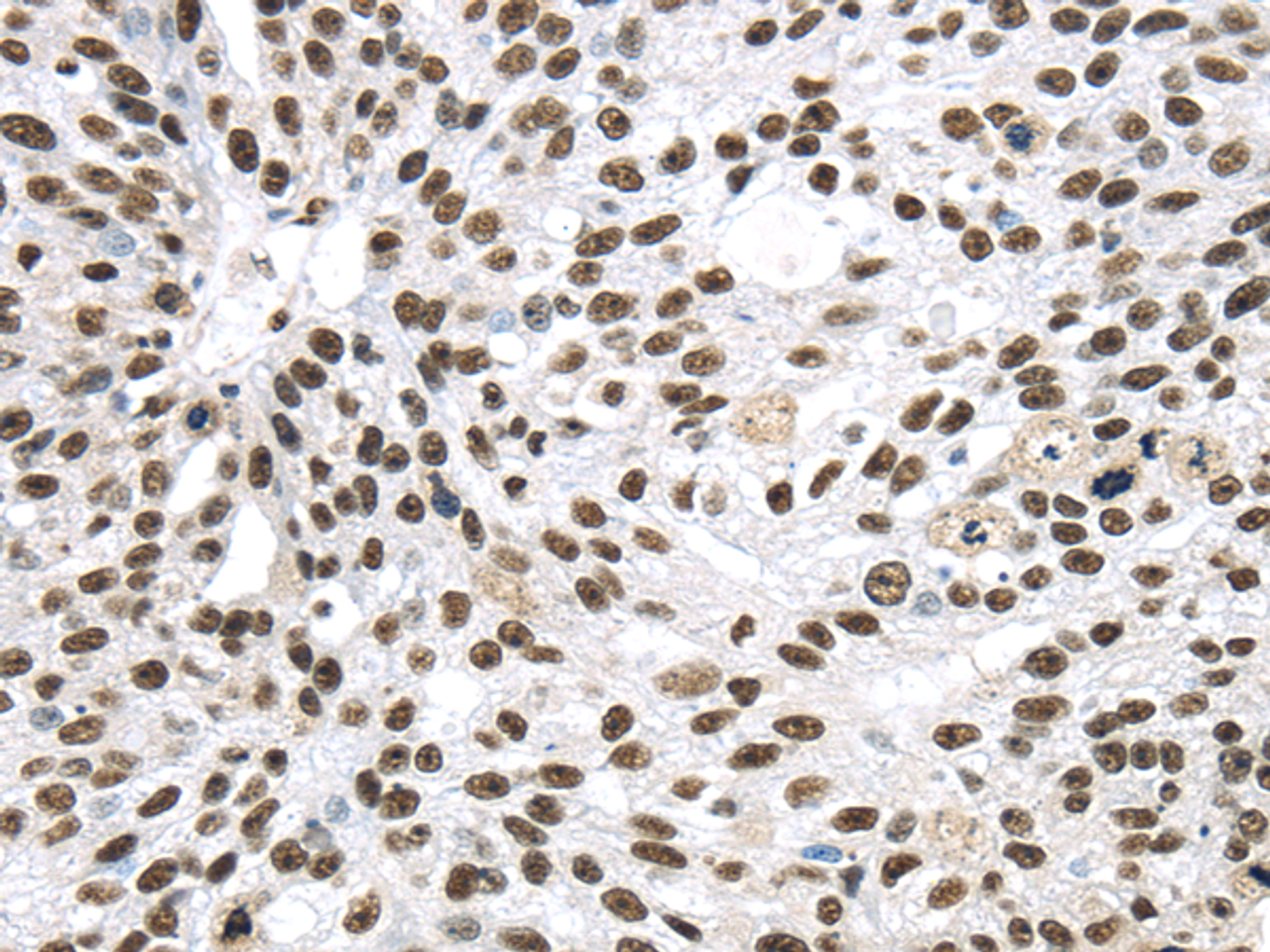Immunohistochemistry of paraffin-embedded Human breast cancer using DDX39B Polyclonal Antibody at dilution of  1/40