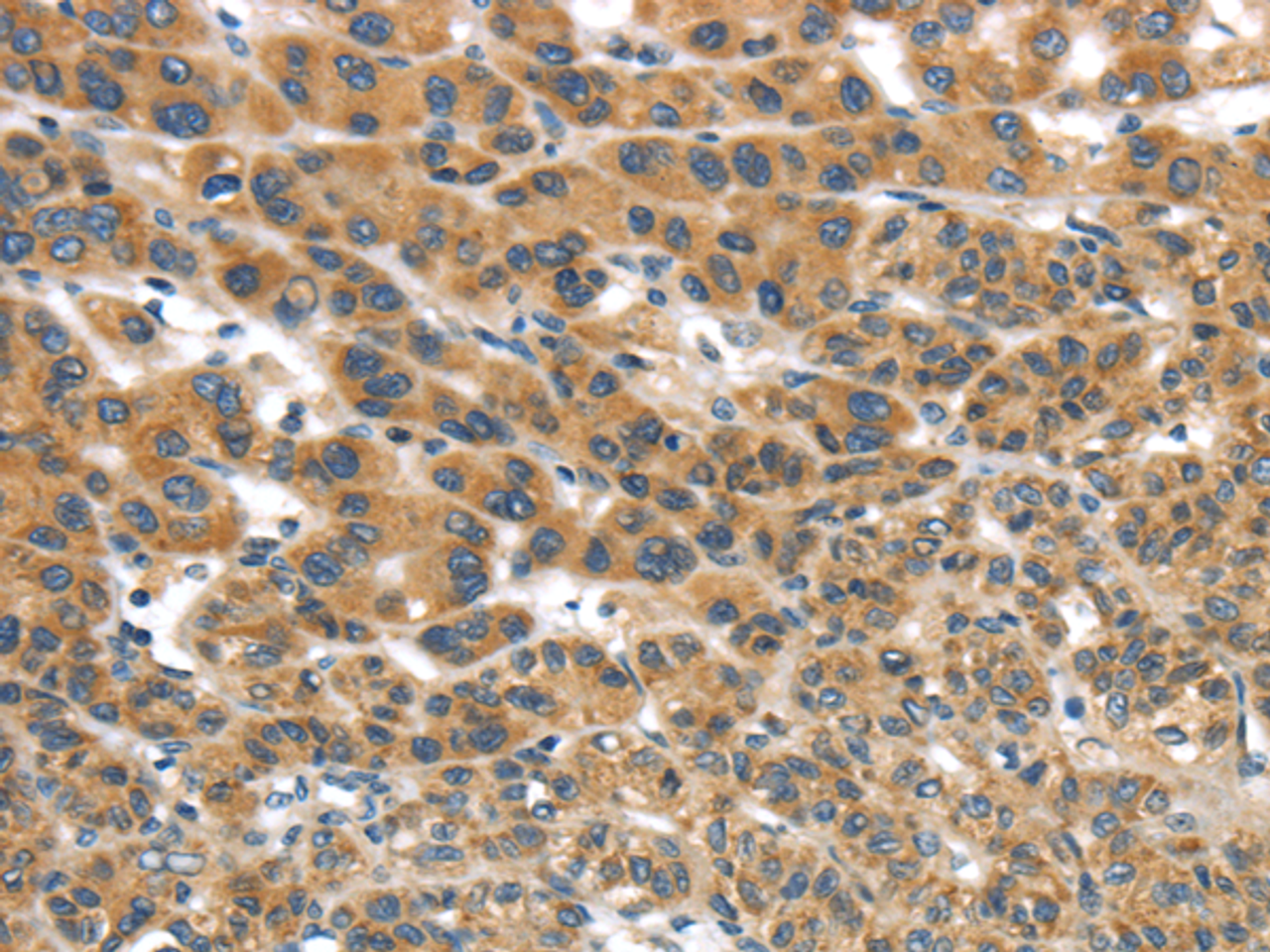 Immunohistochemistry of paraffin-embedded Human liver cancer tissue using UBTD2 Polyclonal Antibody at dilution 1:35