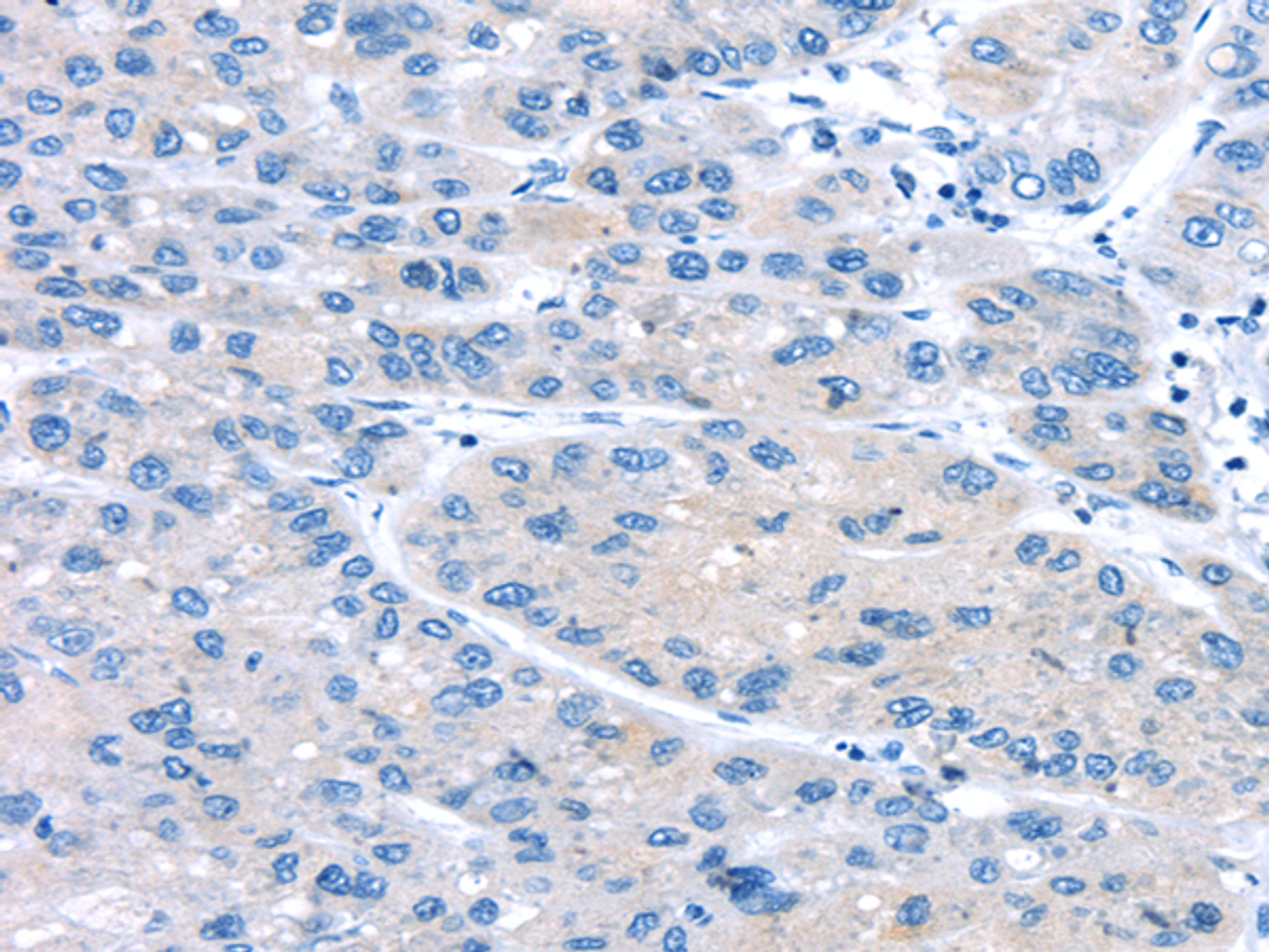 Immunohistochemistry of paraffin-embedded Human liver cancer using UCP2 Polyclonal Antibody at dilution of  1/20