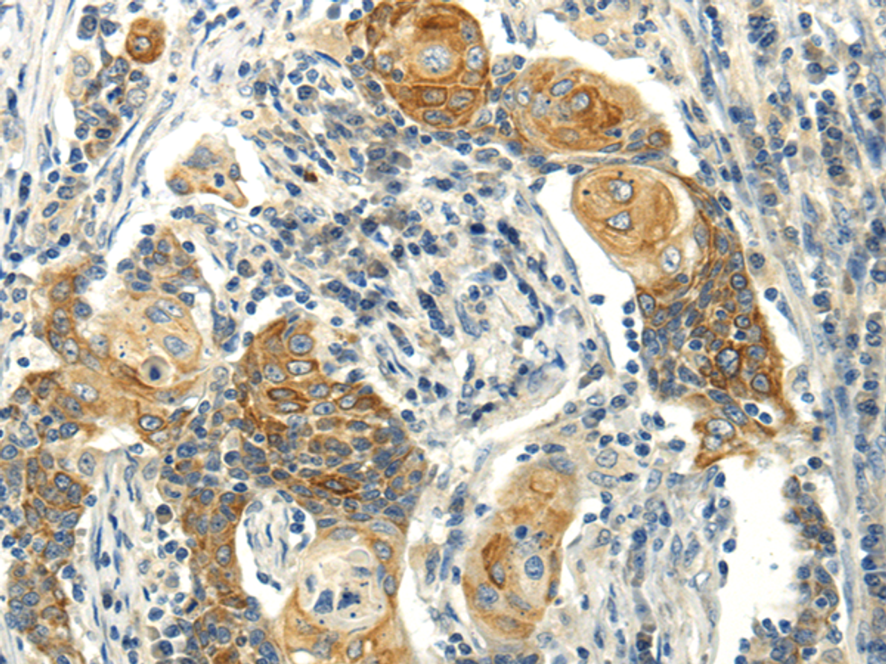 Immunohistochemistry of paraffin-embedded Human cervical cancer using MSI1 Polyclonal Antibody at dilution of  1/30