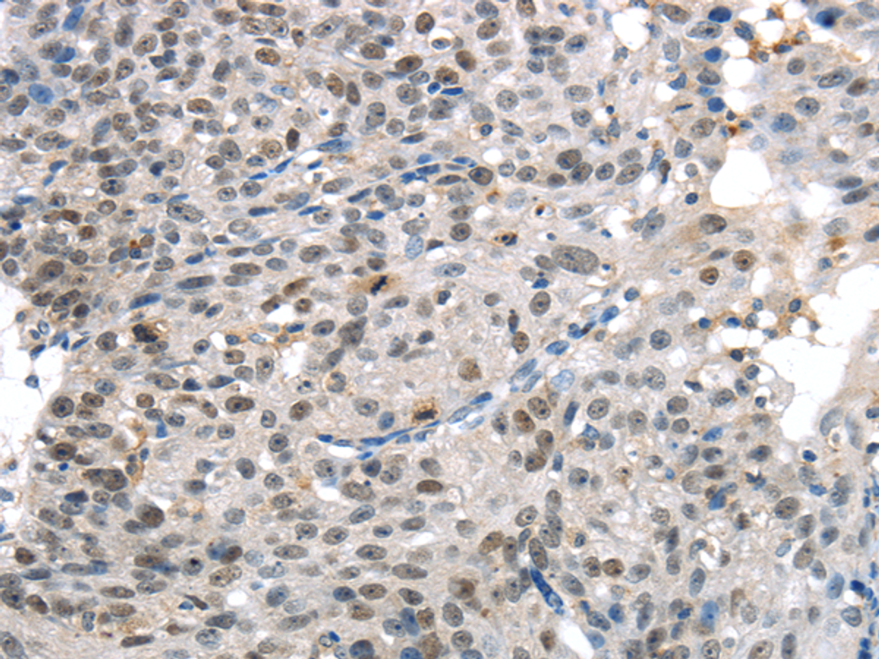 Immunohistochemistry of paraffin-embedded Human breast cancer tissue using KDM5C Polyclonal Antibody at dilution 1:45