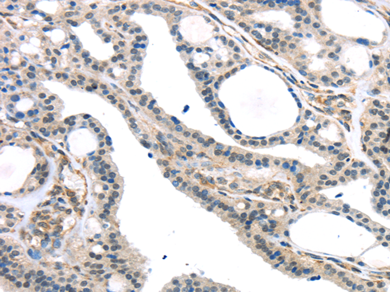Immunohistochemistry of paraffin-embedded Human thyroid cancer tissue using KDM5C Polyclonal Antibody at dilution 1:45