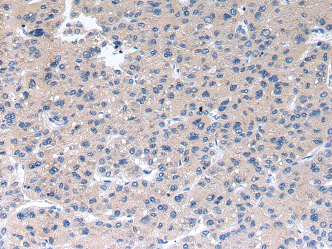 Immunohistochemistry of paraffin-embedded Human liver cancer using RAB2A Polyclonal Antibody at dilution of  1/40