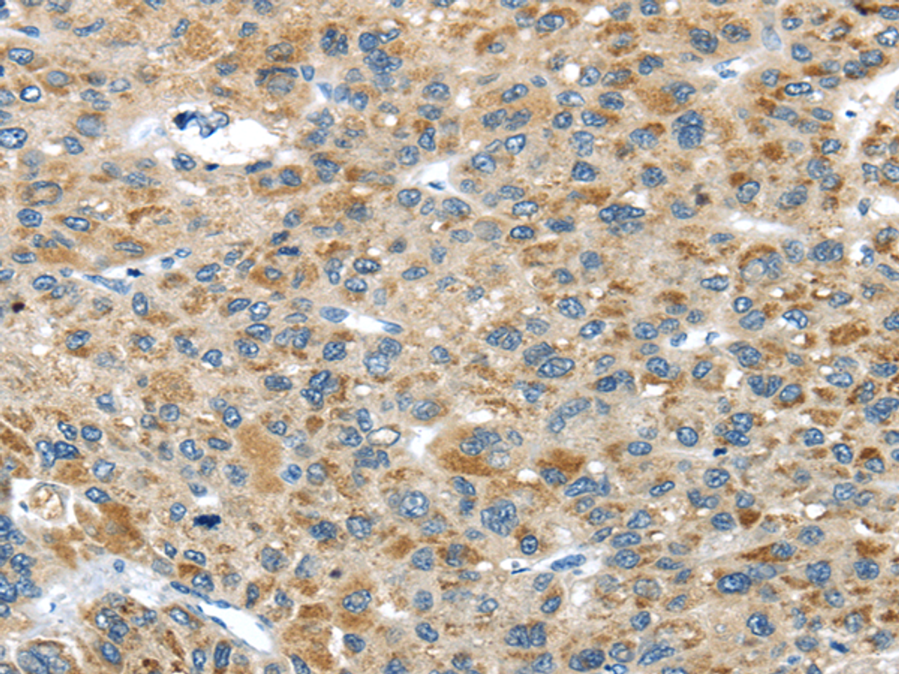 Immunohistochemistry of paraffin-embedded Human liver cancer tissue using USP9X Polyclonal Antibody at dilution 1:40
