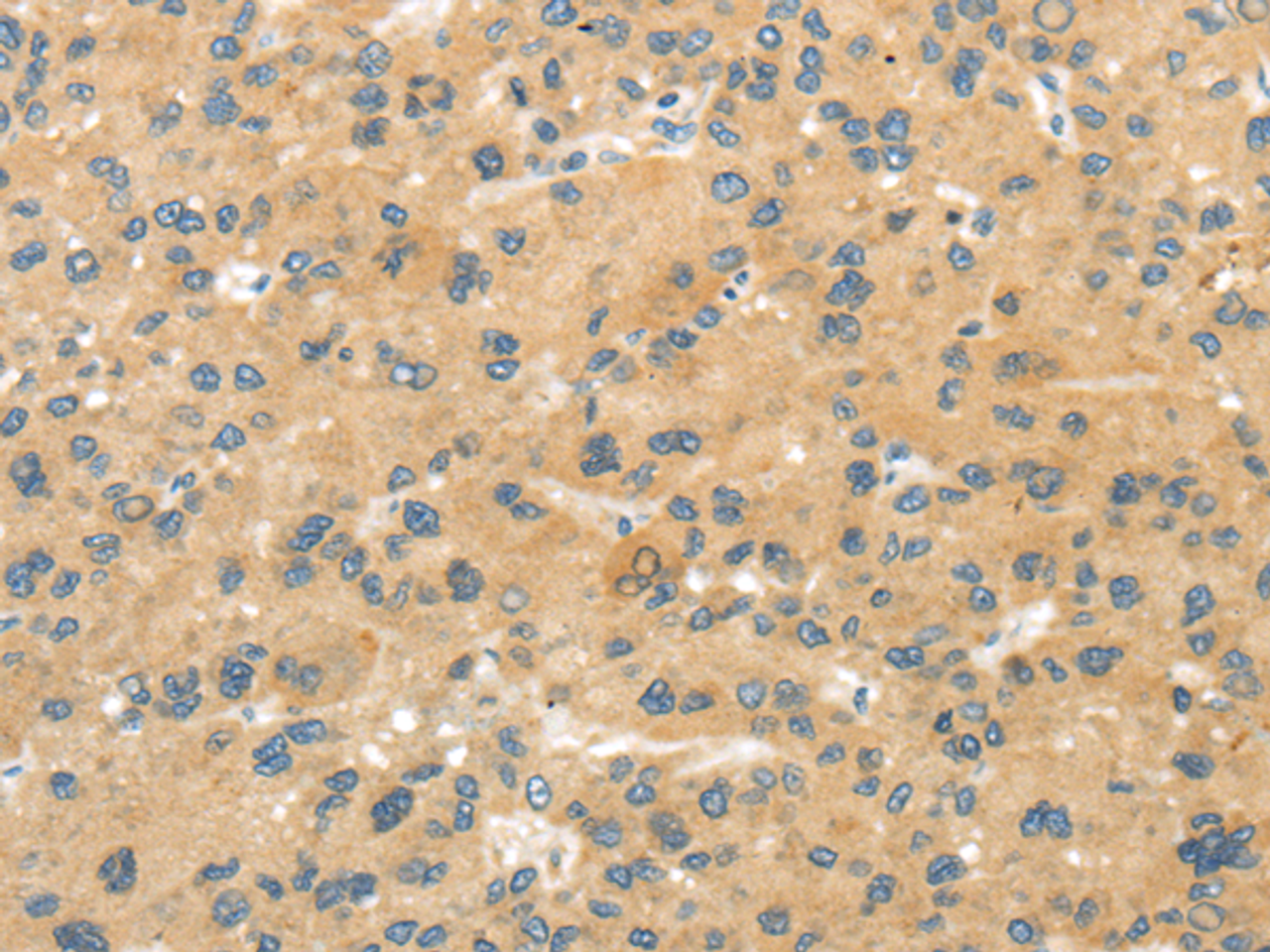 Immunohistochemistry of paraffin-embedded Human liver cancer tissue using MPP6 Polyclonal Antibody at dilution 1:40