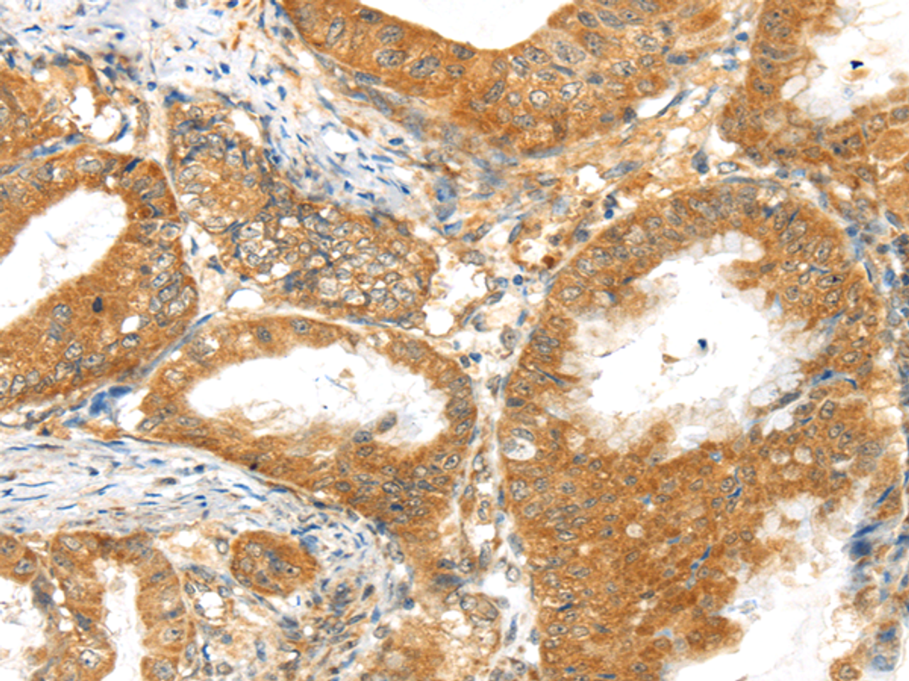 Immunohistochemistry of paraffin-embedded Human esophagus cancer tissue using MPP6 Polyclonal Antibody at dilution 1:40