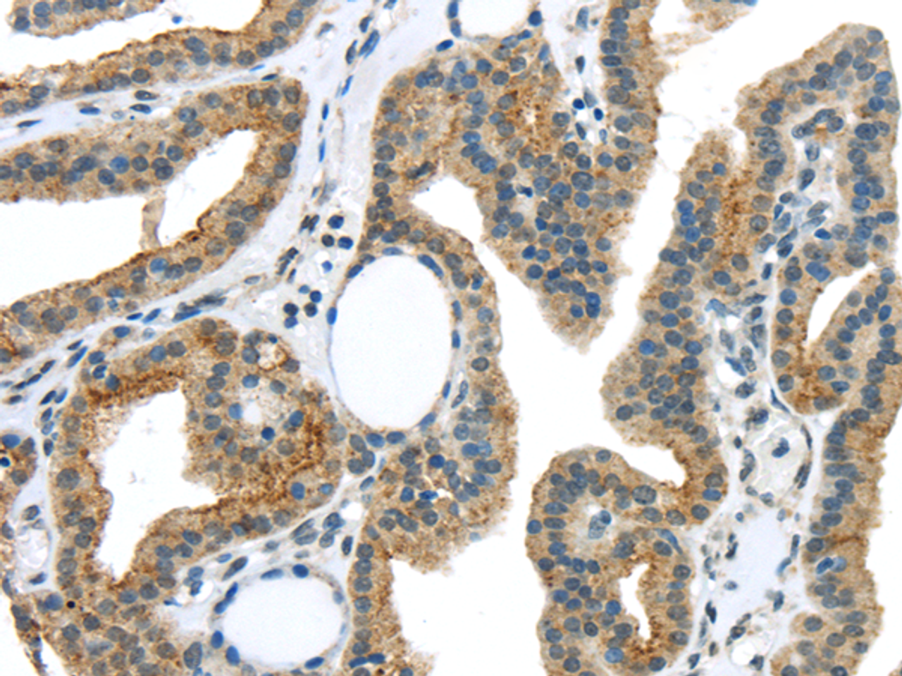 Immunohistochemistry of paraffin-embedded Human thyroid cancer using VAMP2 Polyclonal Antibody at dilution of  1/40