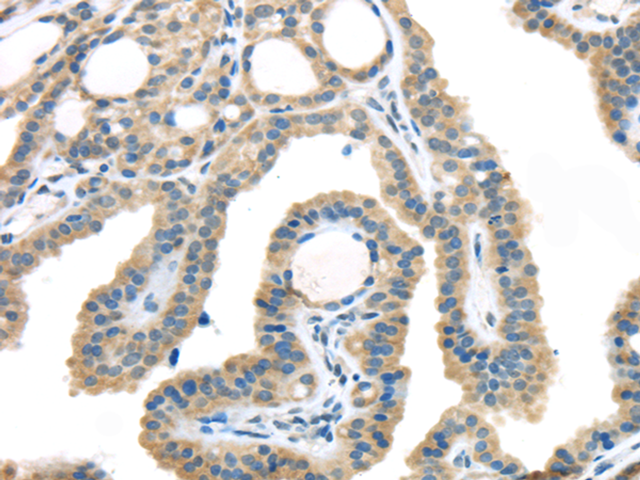 Immunohistochemistry of paraffin-embedded Human thyroid cancer using VGF Polyclonal Antibody at dilution of  1/45