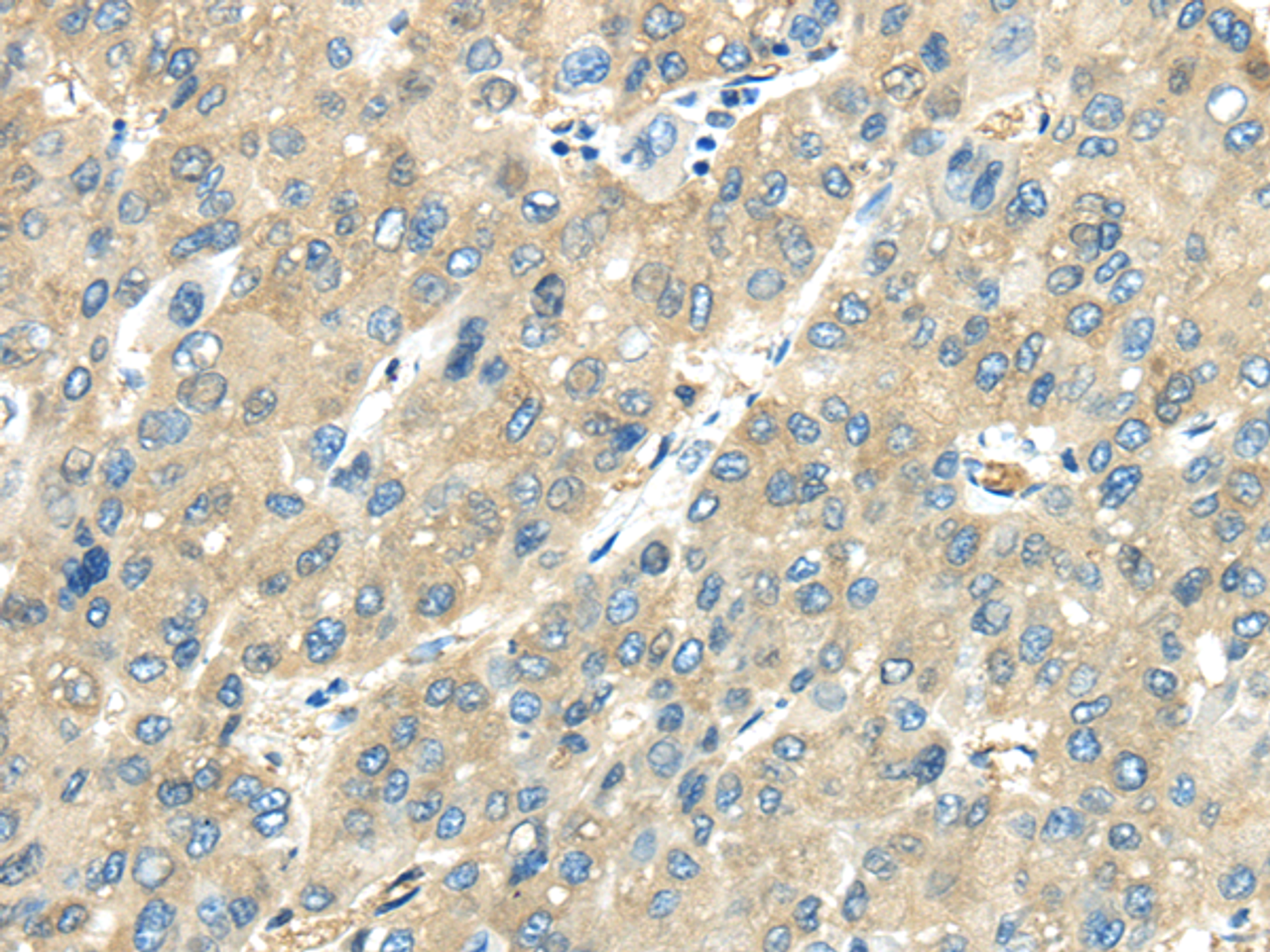 Immunohistochemistry of paraffin-embedded Human liver cancer tissue using VPS4A Polyclonal Antibody at dilution 1:40