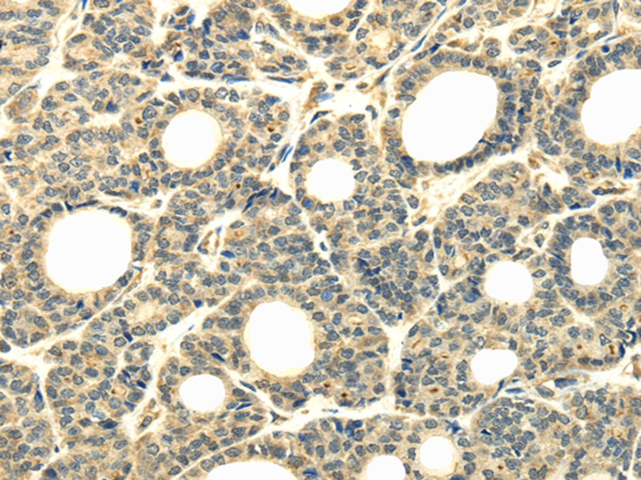 Immunohistochemistry of paraffin-embedded Human thyroid cancer tissue using WDR45B Polyclonal Antibody at dilution 1:40