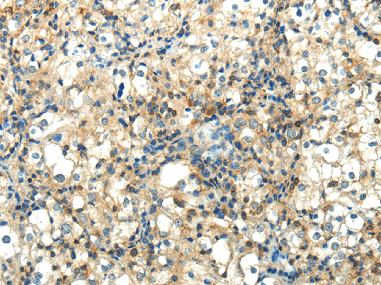 Immunohistochemistry of paraffin-embedded Human prostate cancer using WNT2 Polyclonal Antibody at dilution of  1/40
