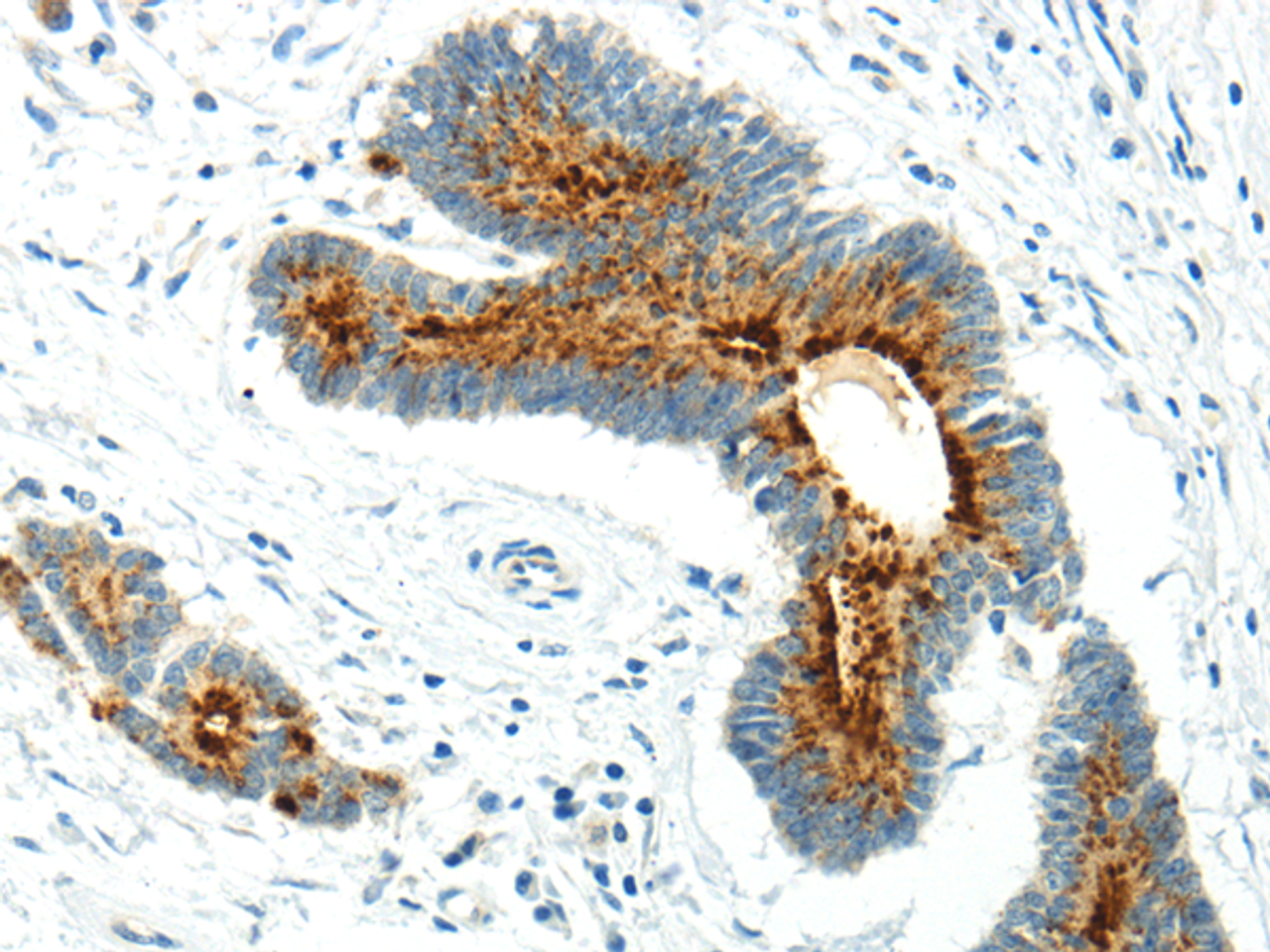Immunohistochemistry of paraffin-embedded Human colorectal cancer using WWOX Polyclonal Antibody at dilution of  1/20