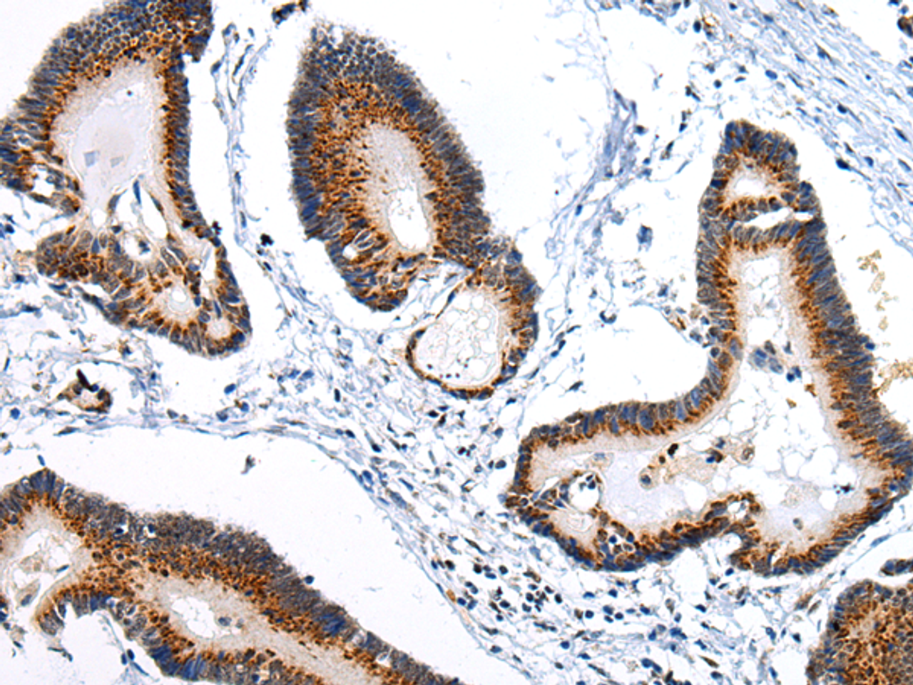 Immunohistochemistry of paraffin-embedded Human colorectal cancer using ARFGAP2 Polyclonal Antibody at dilution of  1/25