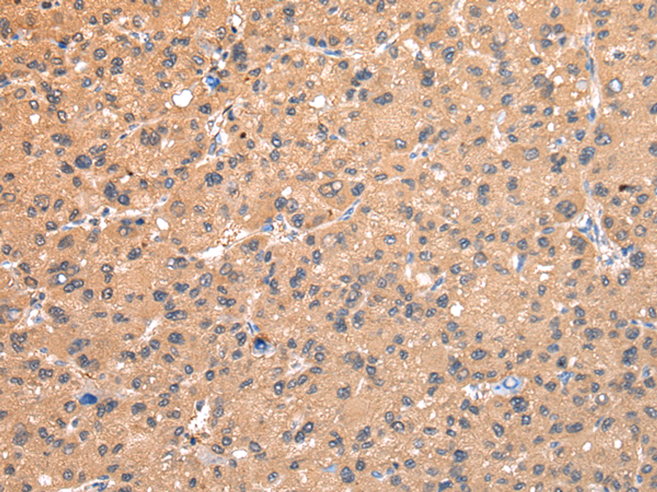 Immunohistochemistry of paraffin-embedded Human liver cancer using AP2A1 Polyclonal Antibody at dilution of  1/20