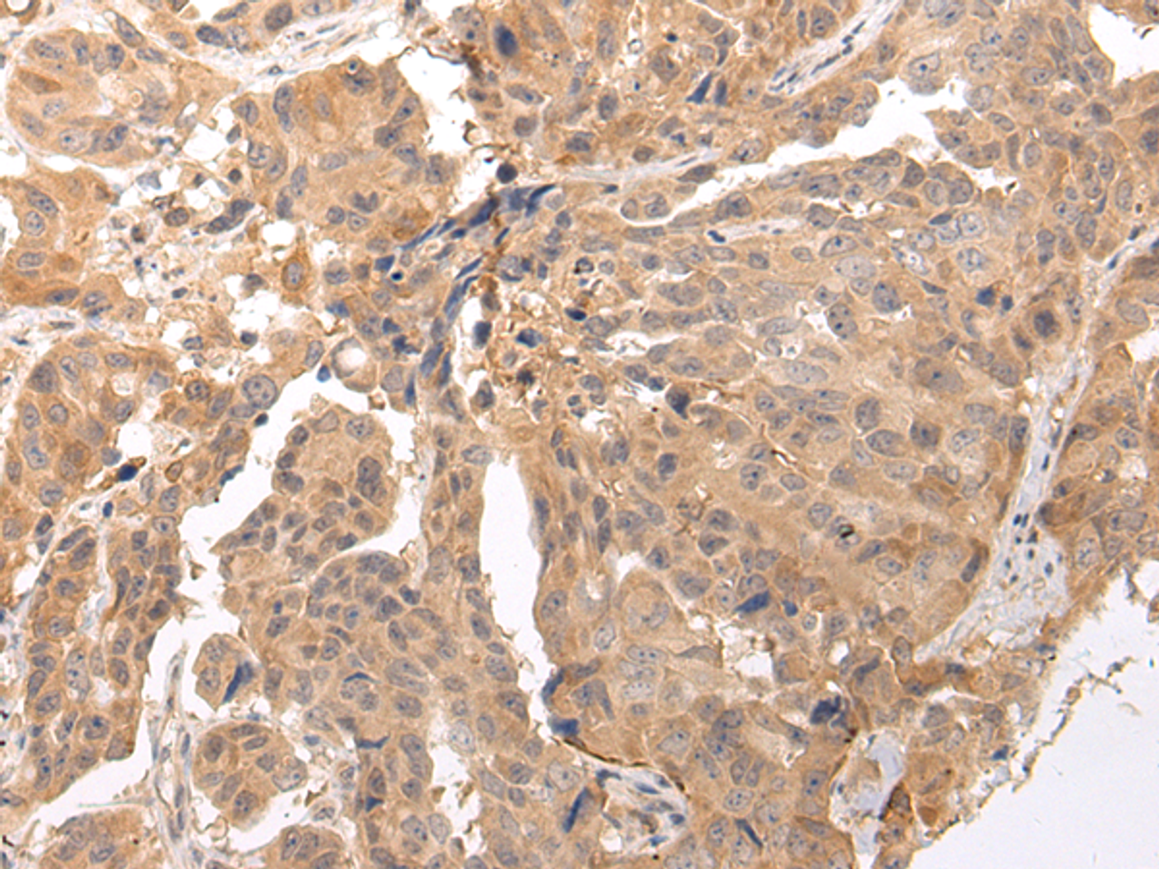 Immunohistochemistry of paraffin-embedded Human breast cancer tissue using CLDND2 Polyclonal Antibody at dilution 1:45