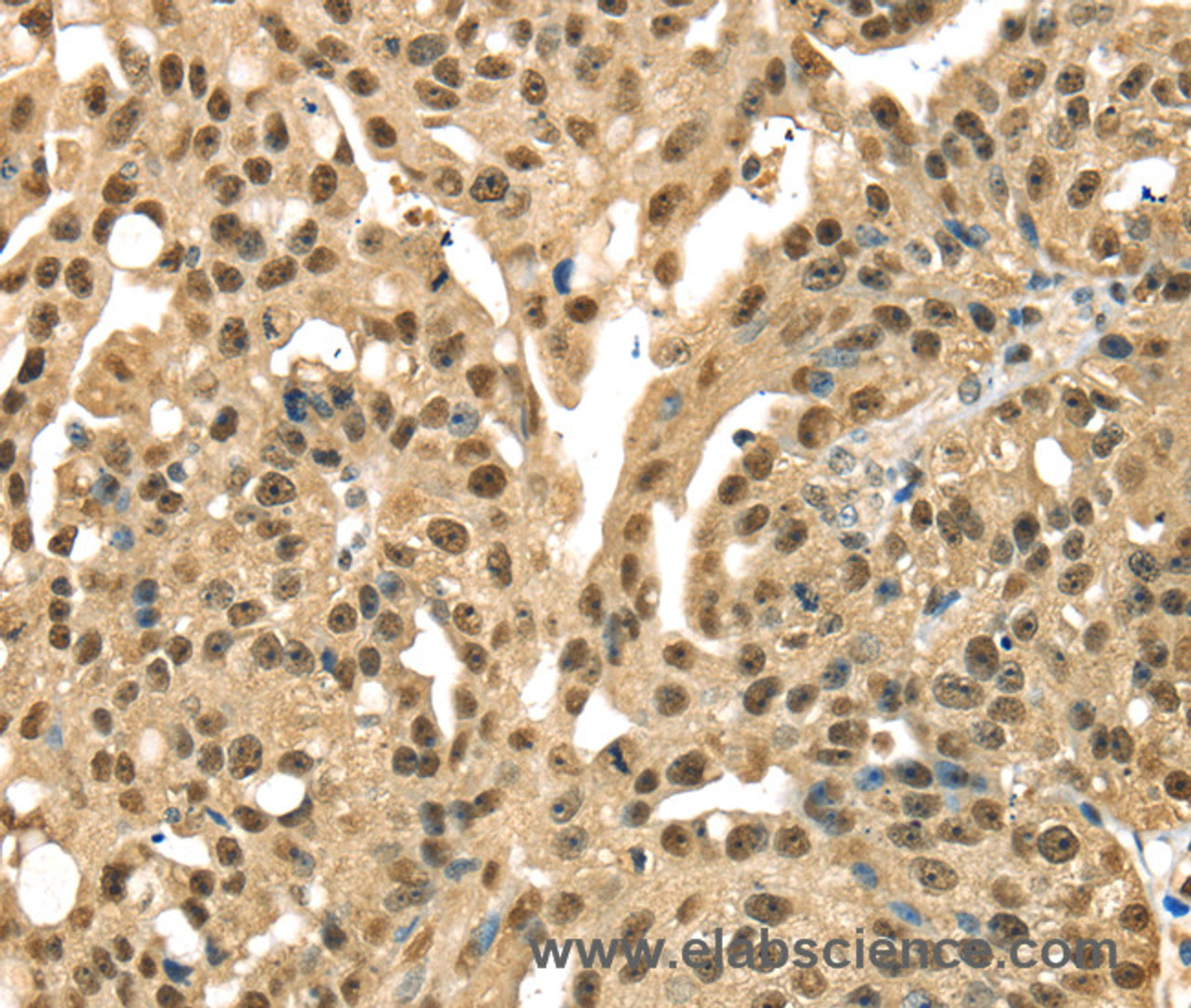 Immunohistochemistry of paraffin-embedded Human esophagus cancer tissue using DFFA Polyclonal Antibody at dilution 1:40