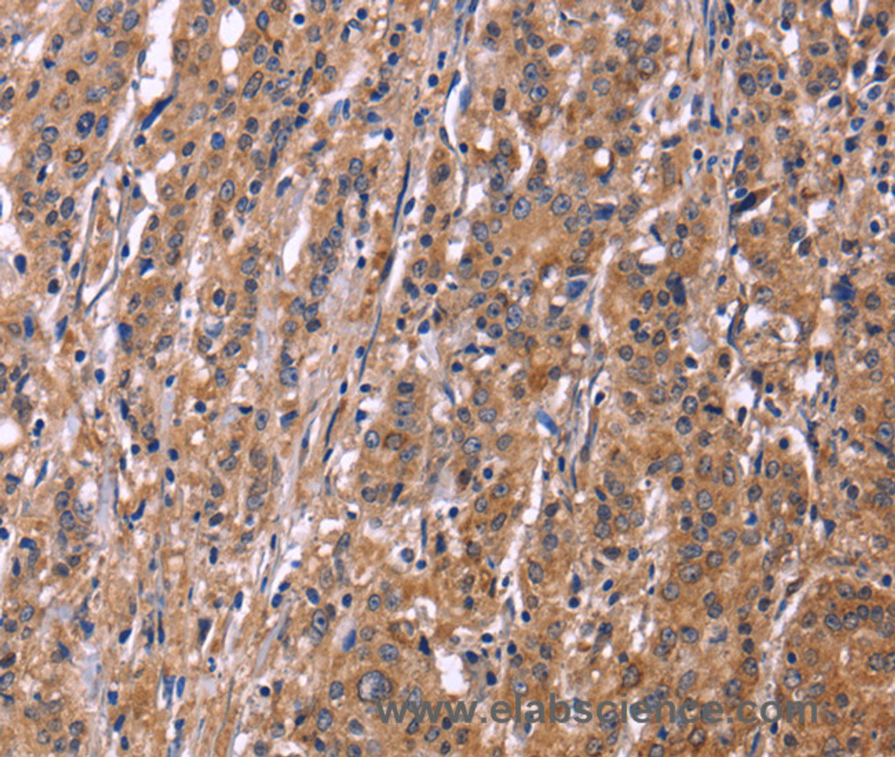 Immunohistochemistry of paraffin-embedded Human gastric cancer using SEPT7 Polyclonal Antibody at dilution of 1:50
