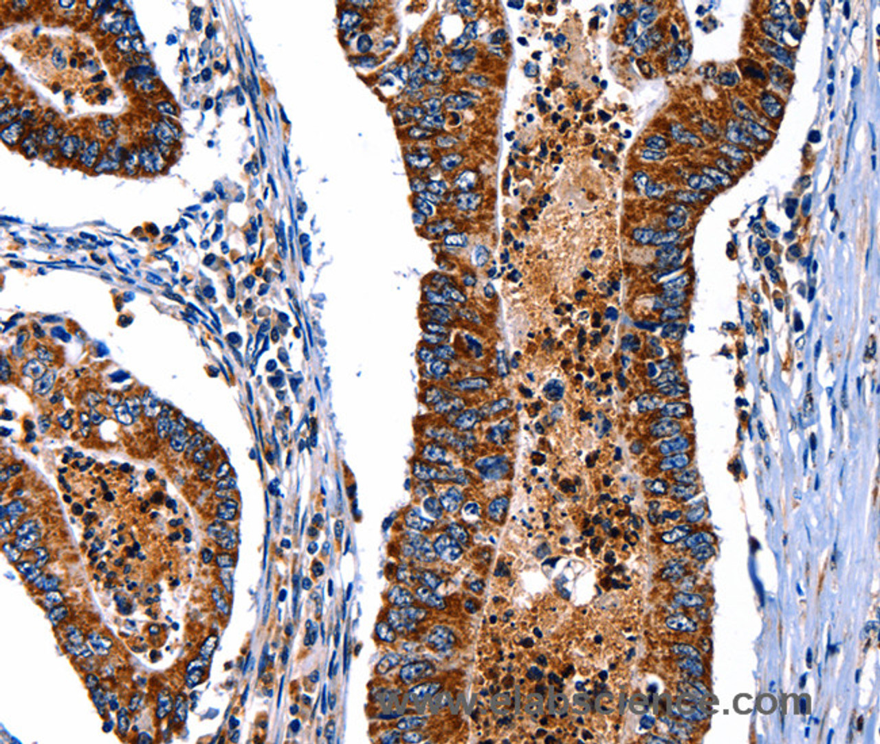 Immunohistochemistry of paraffin-embedded Human colon cancer tissue using ITGA7 Polyclonal Antibody at dilution 1:35
