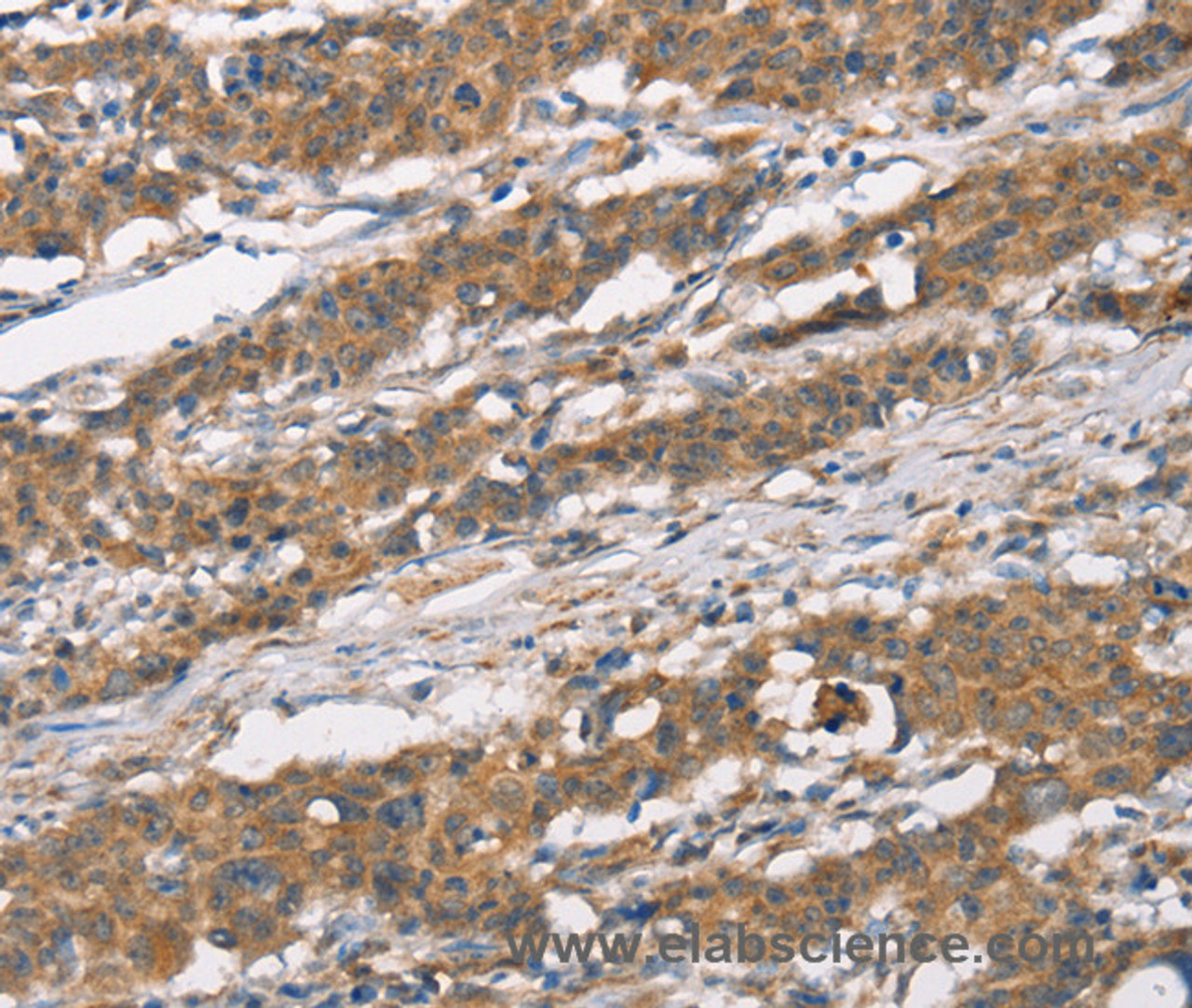 Immunohistochemistry of paraffin-embedded Human thyroid cancer using MARC1 Polyclonal Antibody at dilution of 1:40