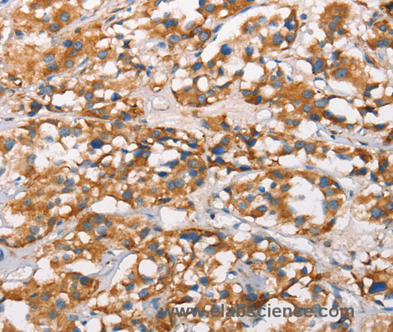 Immunohistochemistry of paraffin-embedded Human thyroid cancer using MARC1 Polyclonal Antibody at dilution of 1:40