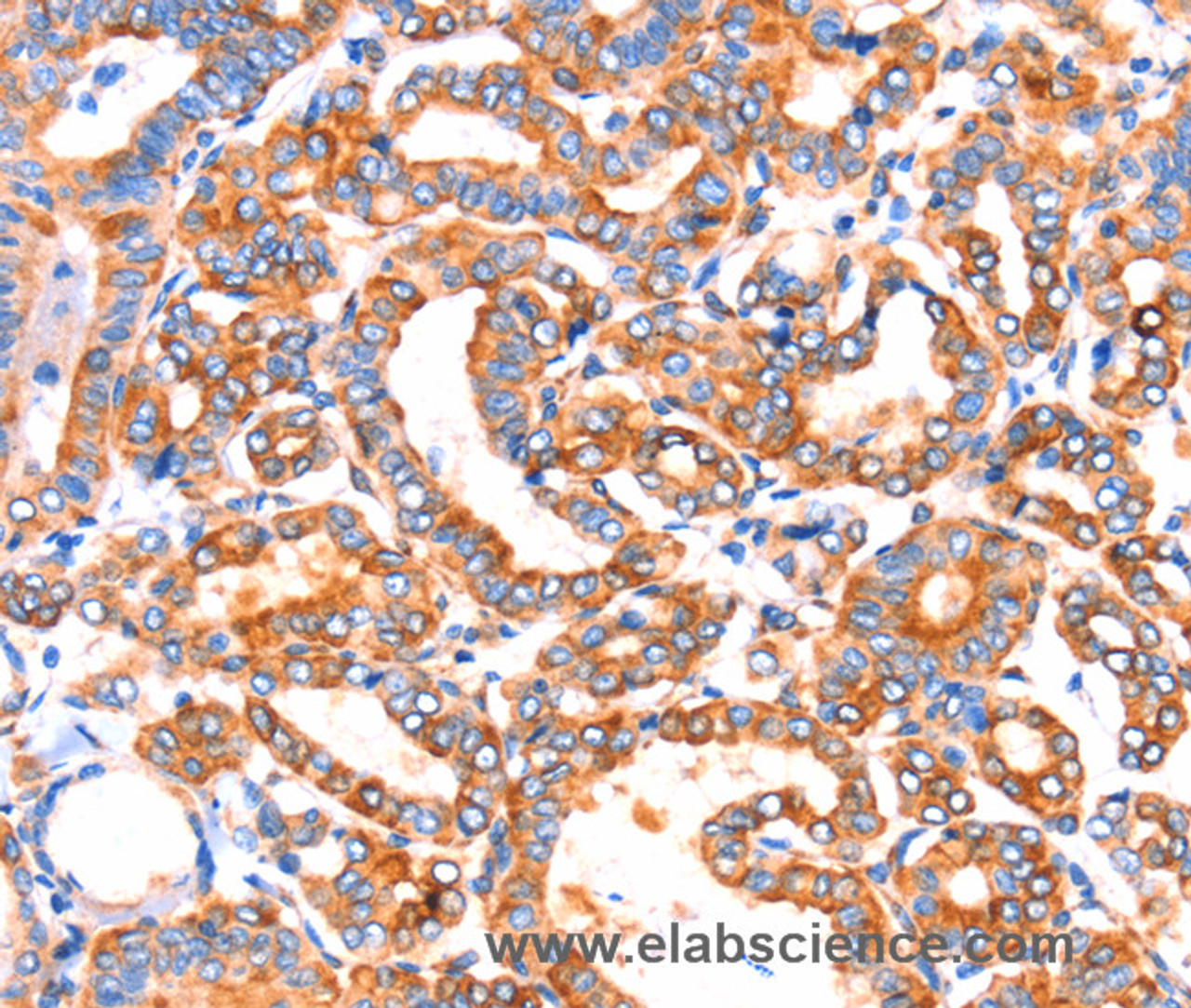 Immunohistochemistry of paraffin-embedded Human thyroid cancer tissue using SEPT4 Polyclonal Antibody at dilution 1:50