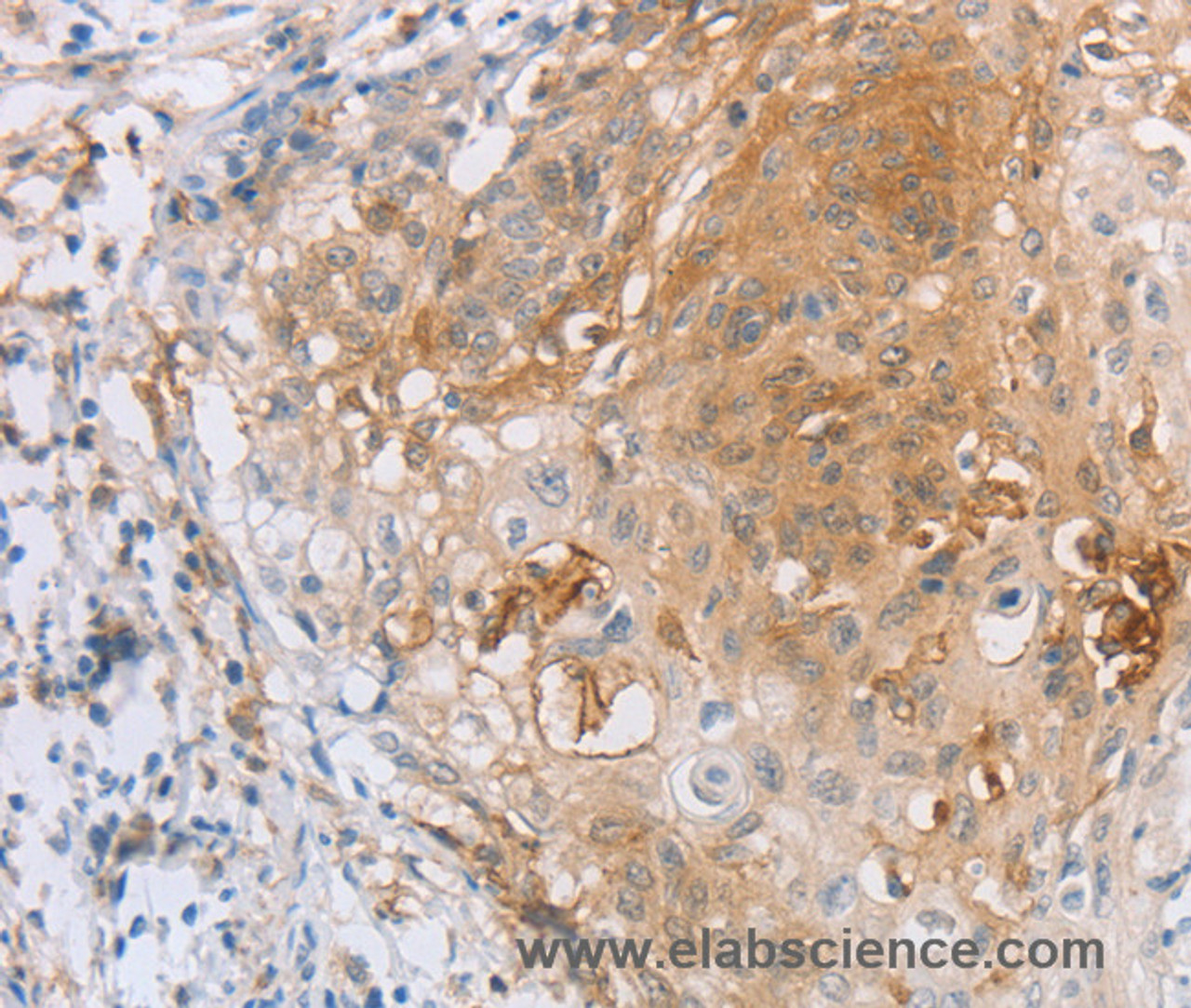 Immunohistochemistry of paraffin-embedded Human cervical cancer tissue using CD85d Polyclonal Antibody at dilution 1:30