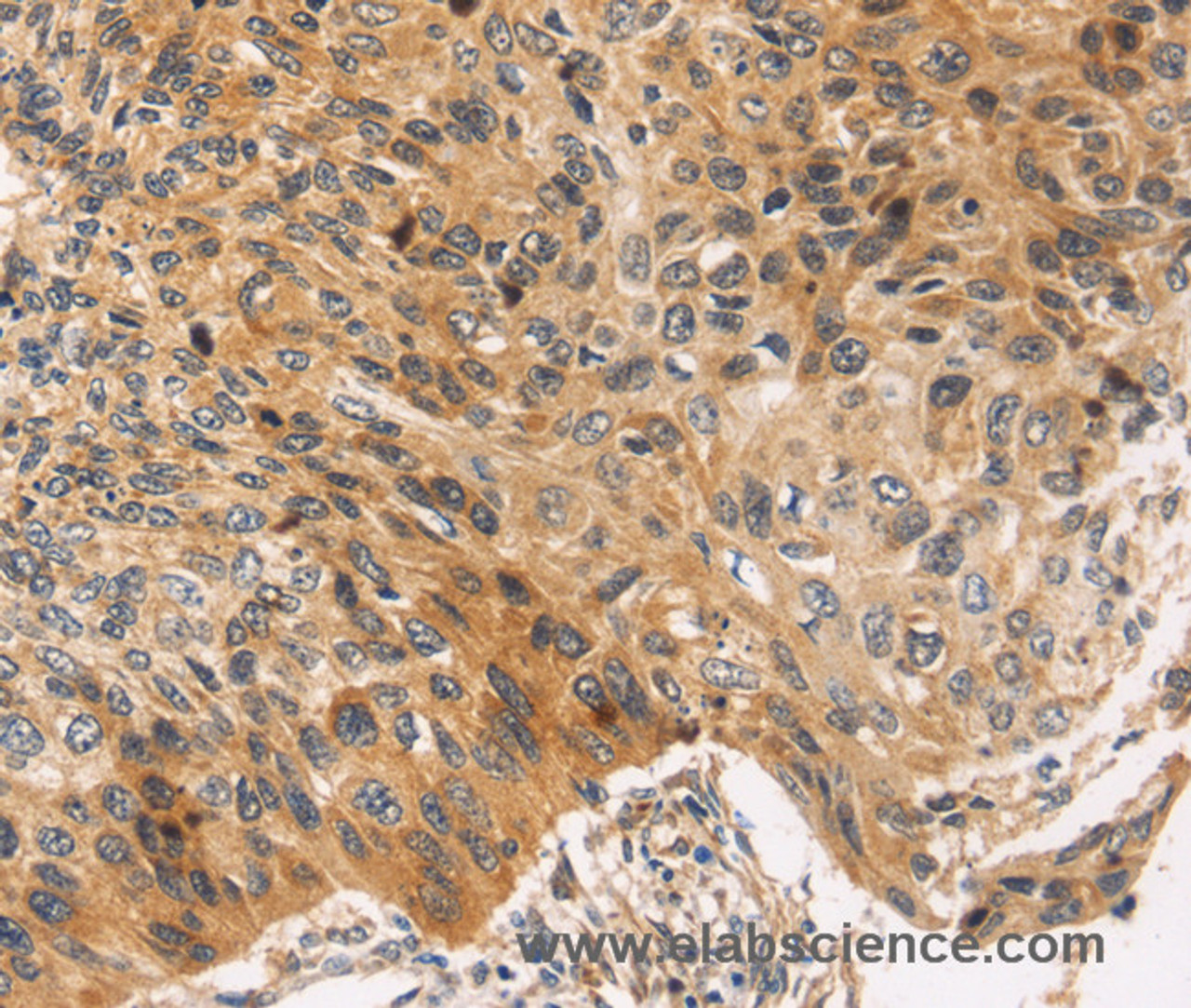 Immunohistochemistry of paraffin-embedded Human esophagus cancer using JNK2 Polyclonal Antibody at dilution of 1:30