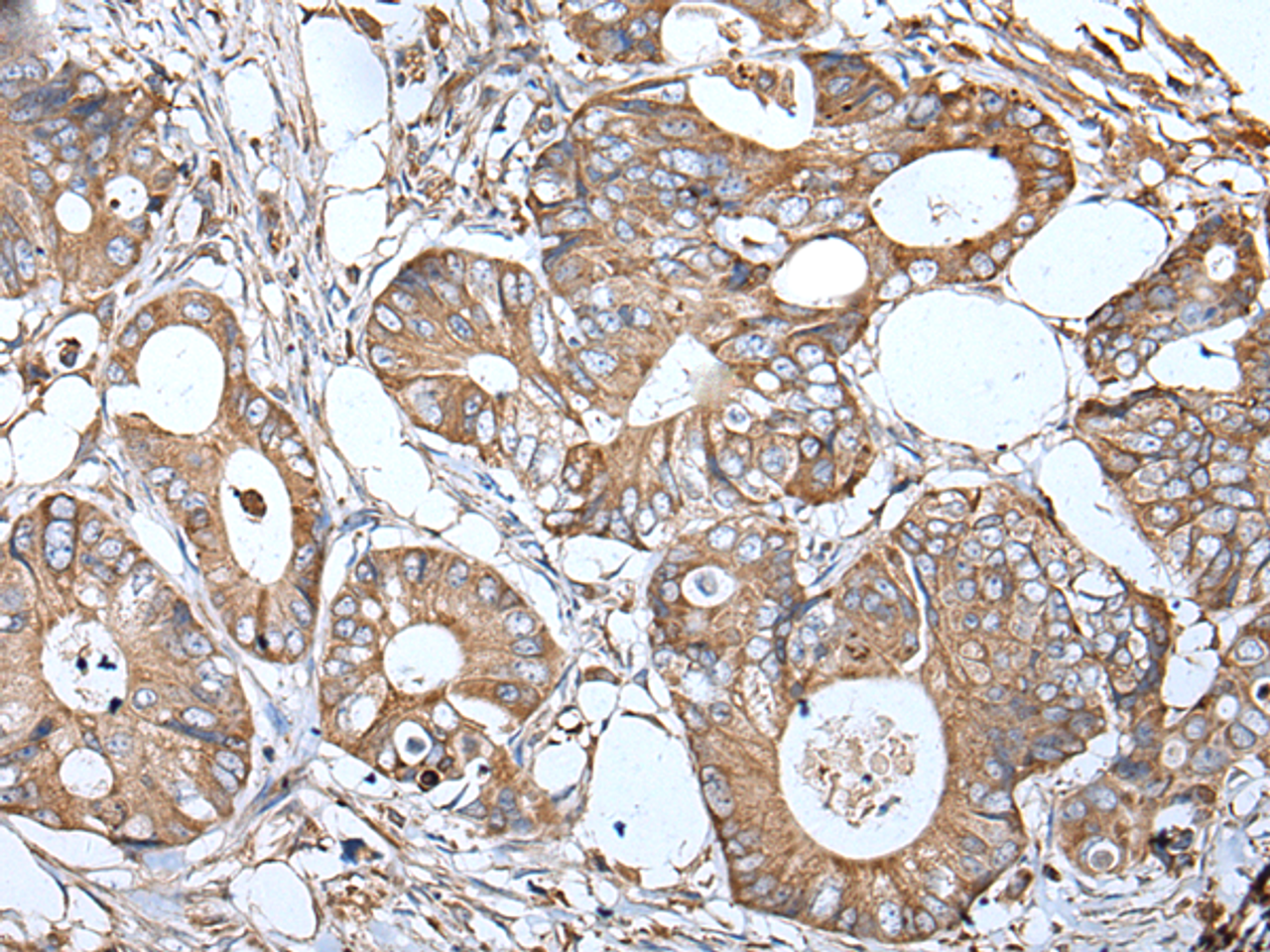 Immunohistochemistry of paraffin-embedded Human colorectal cancer tissue  using APOD Polyclonal Antibody at dilution of 1:55(×200)