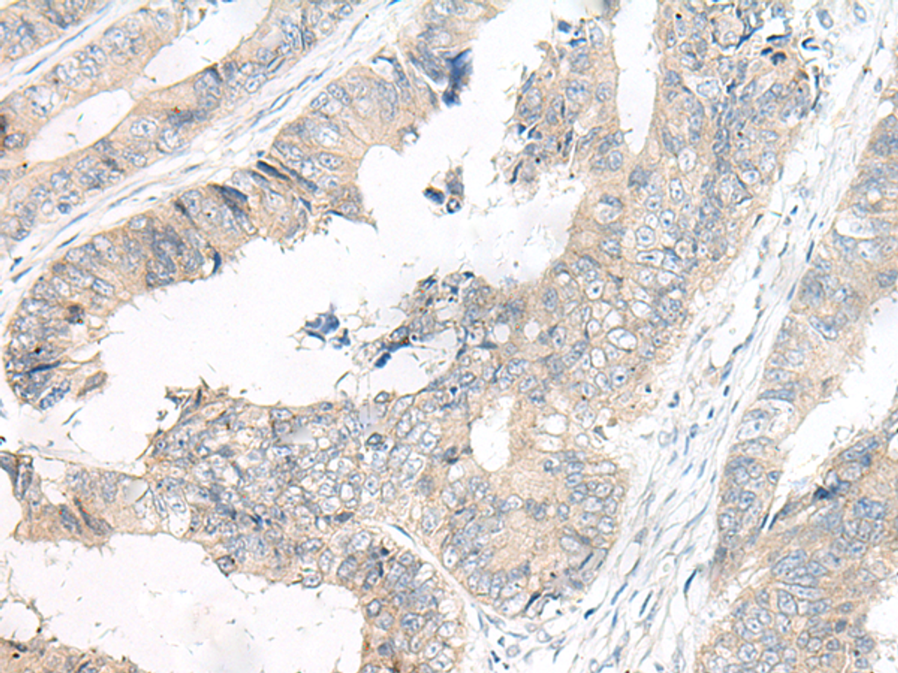 Immunohistochemistry of paraffin-embedded Human colorectal cancer tissue  using FGF10 Polyclonal Antibody at dilution of 1:30(×200)
