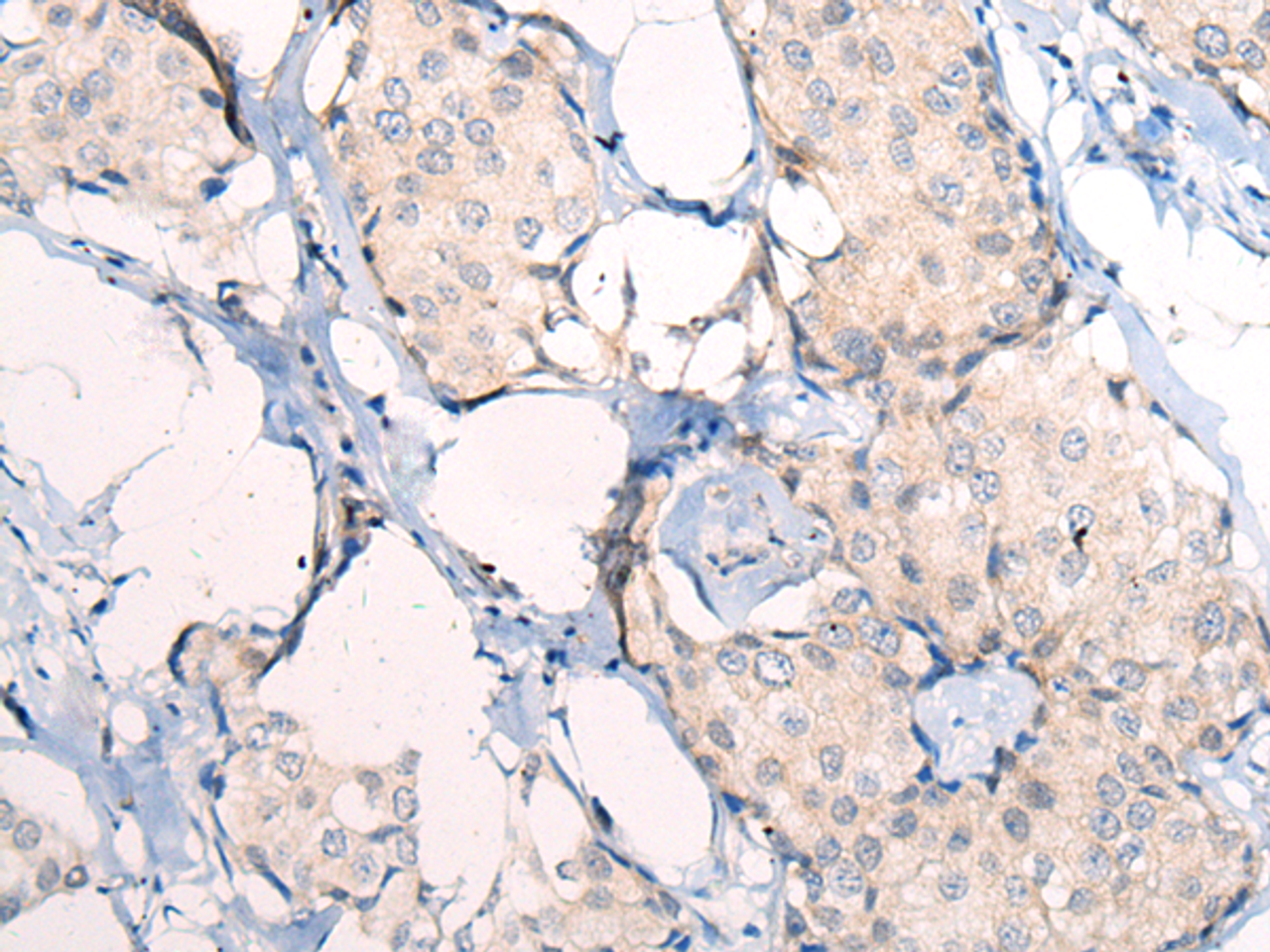 Immunohistochemistry of paraffin-embedded Human breast cancer tissue  using ANAPC15 Polyclonal Antibody at dilution of 1:50(×200)