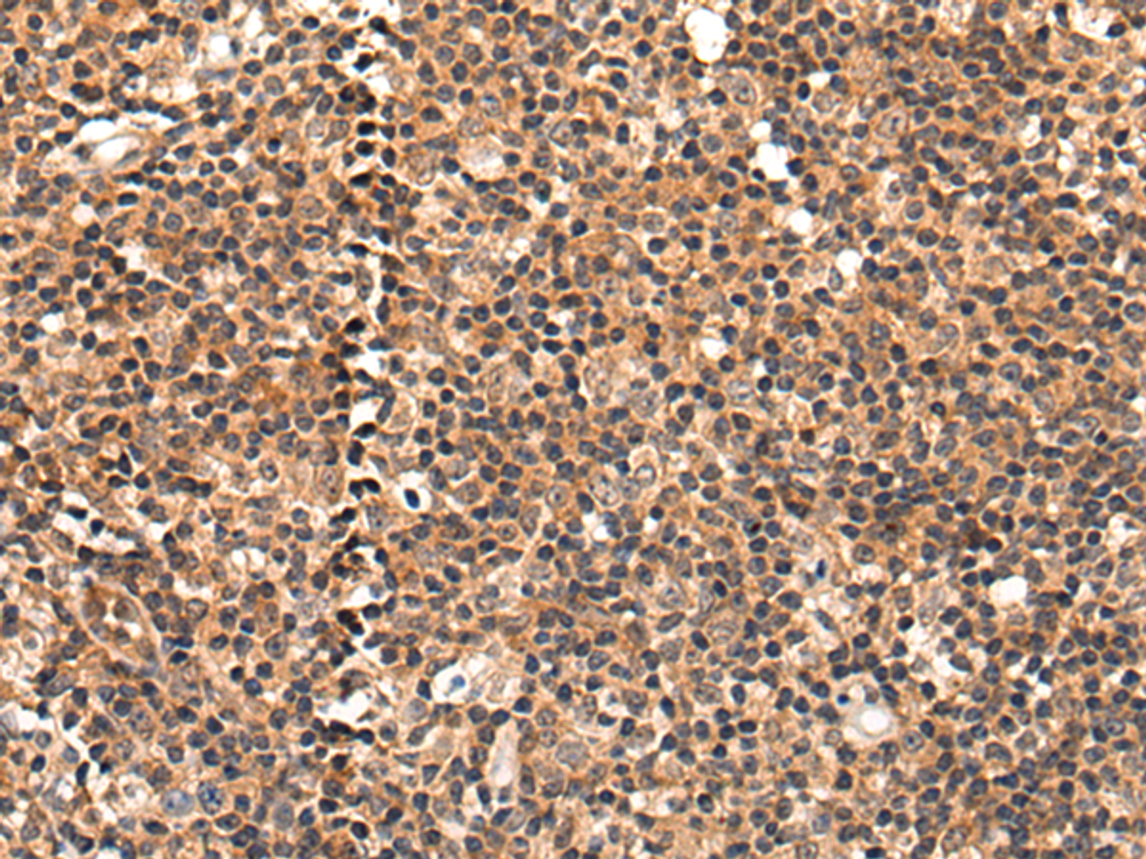 Immunohistochemistry of paraffin-embedded Human tonsil tissue  using C16orf45 Polyclonal Antibody at dilution of 1:45(×200)