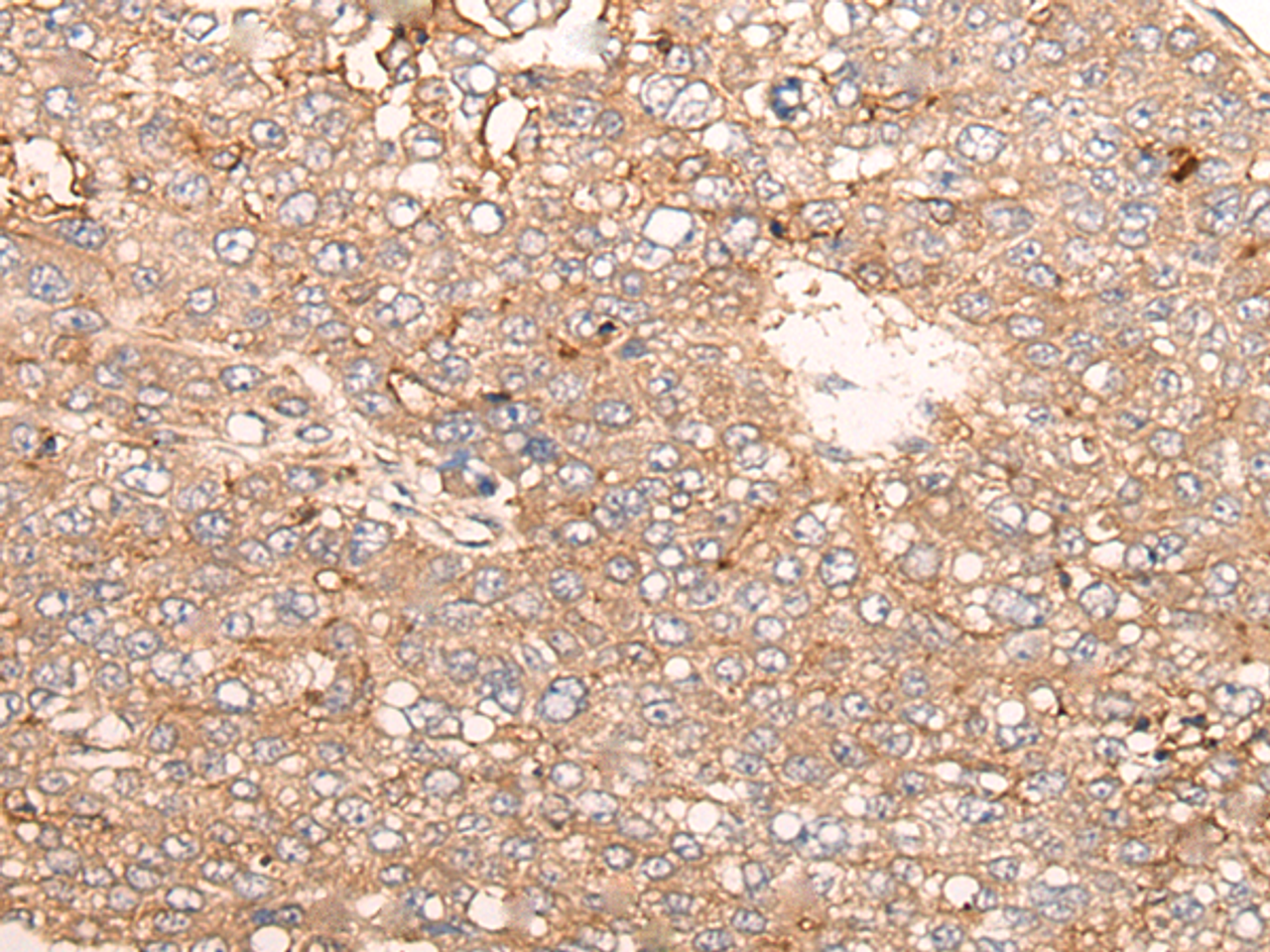 Immunohistochemistry of paraffin-embedded Human liver cancer tissue  using SIGLECL1 Polyclonal Antibody at dilution of 1:65(×200)