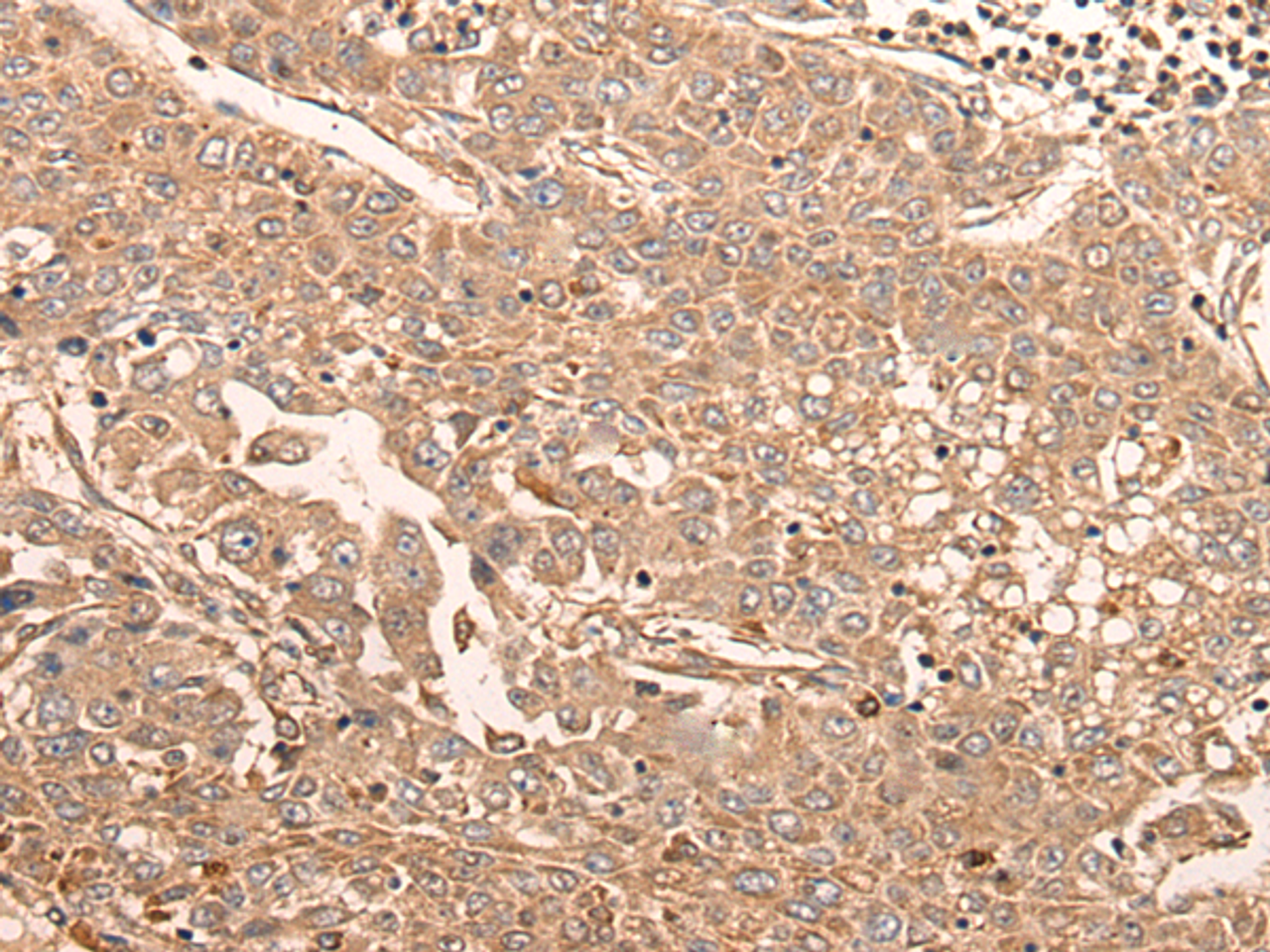 Immunohistochemistry of paraffin-embedded Human liver cancer tissue  using LDAH Polyclonal Antibody at dilution of 1:55(×200)