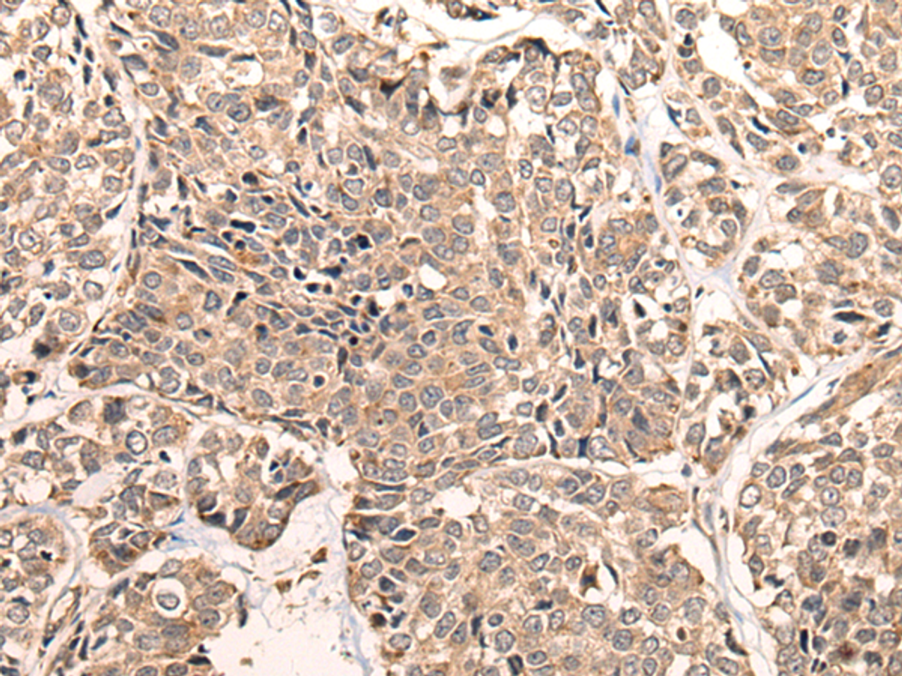 Immunohistochemistry of paraffin-embedded Human esophagus cancer tissue  using LDAH Polyclonal Antibody at dilution of 1:55(×200)
