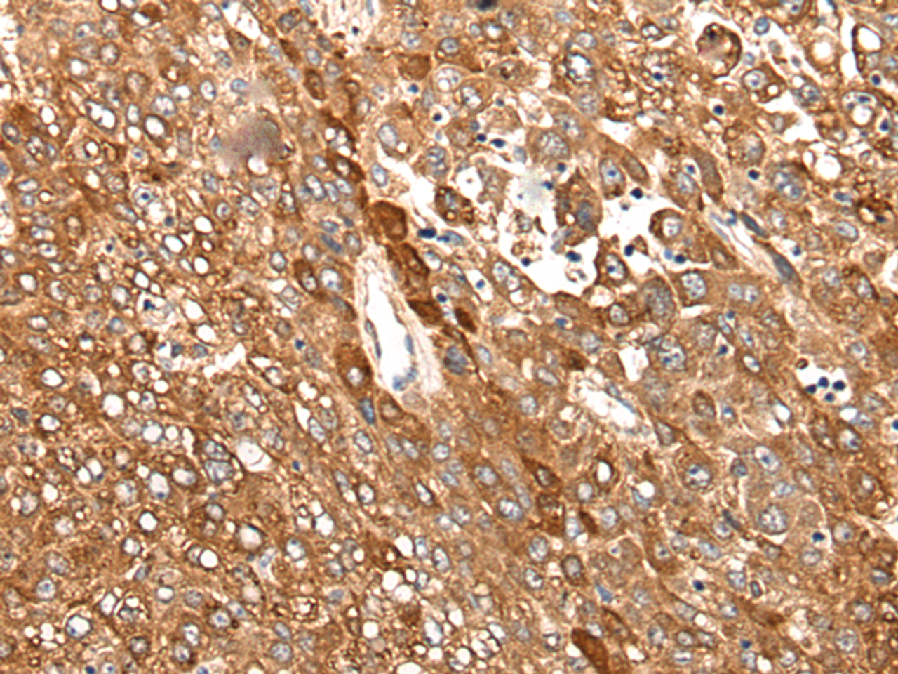 Immunohistochemistry of paraffin-embedded Human liver cancer tissue  using CAD Polyclonal Antibody at dilution of 1:50(×200)